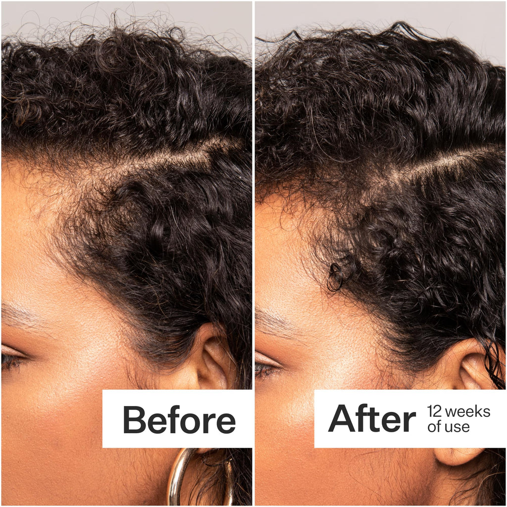 ACT+ ACRE Thick + Full Hair Capsules - Vegan Hair Support, 60ct