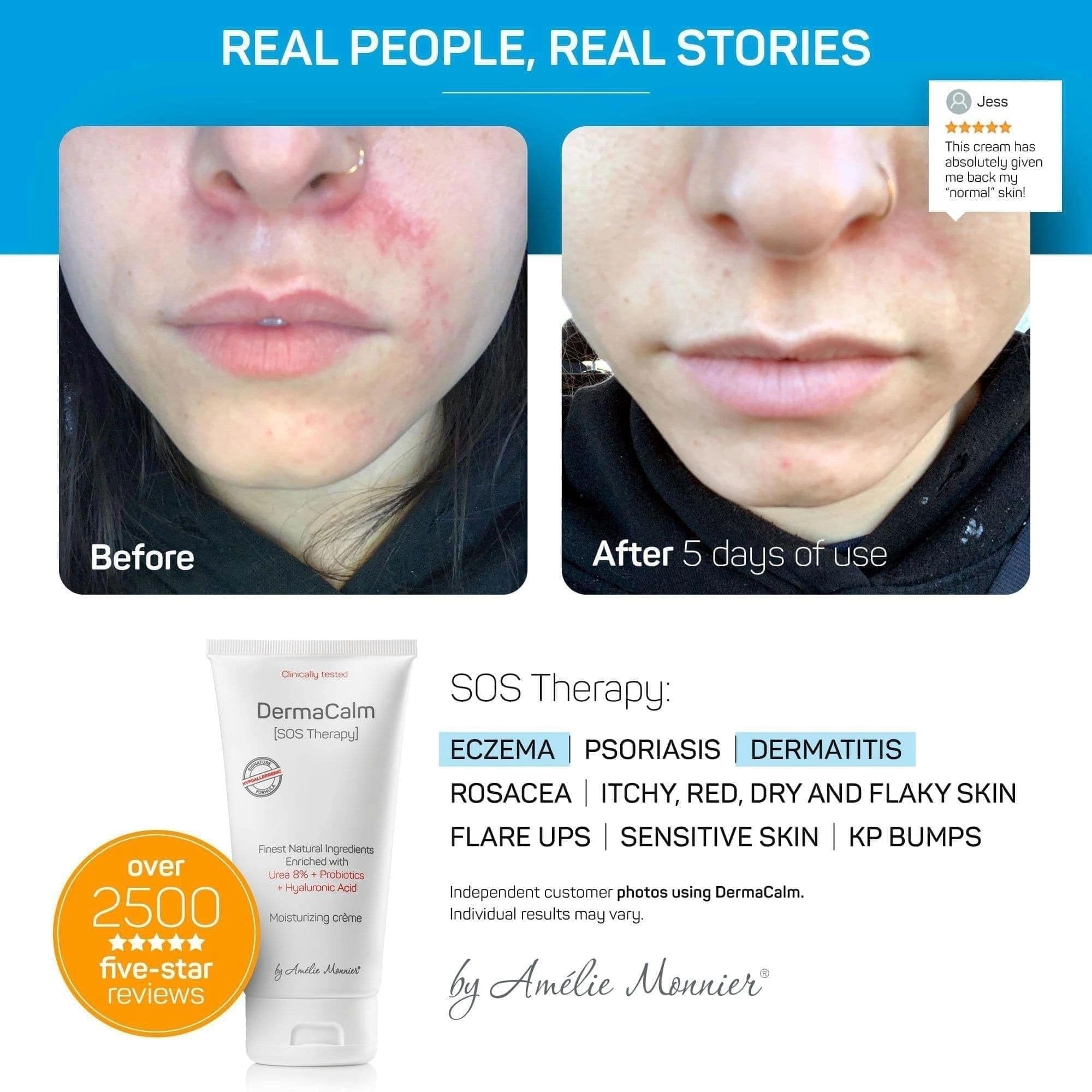 Amélie Monnier Clinically Tested DermaCalm SOS Therapy – Eczema & Dry Skin with Urea 8%, Probiotics