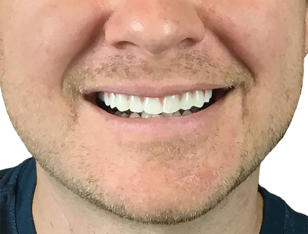 2 Pack Instant Smile Natural Shade Comfort Fit Flex Veneers – Fix Your Smile at Home in Minutes | Hand Crafted