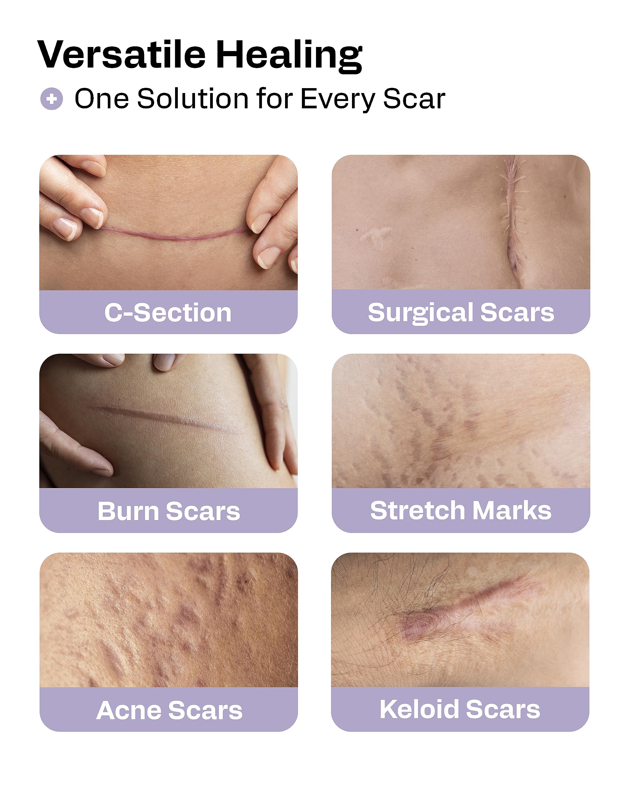 AWD Silicone Scar Tape Roll 60in – Medical-Grade Scar Tape for Surgical Scars, C-Section, Tummy Tuck, Reusable Scar Sheets