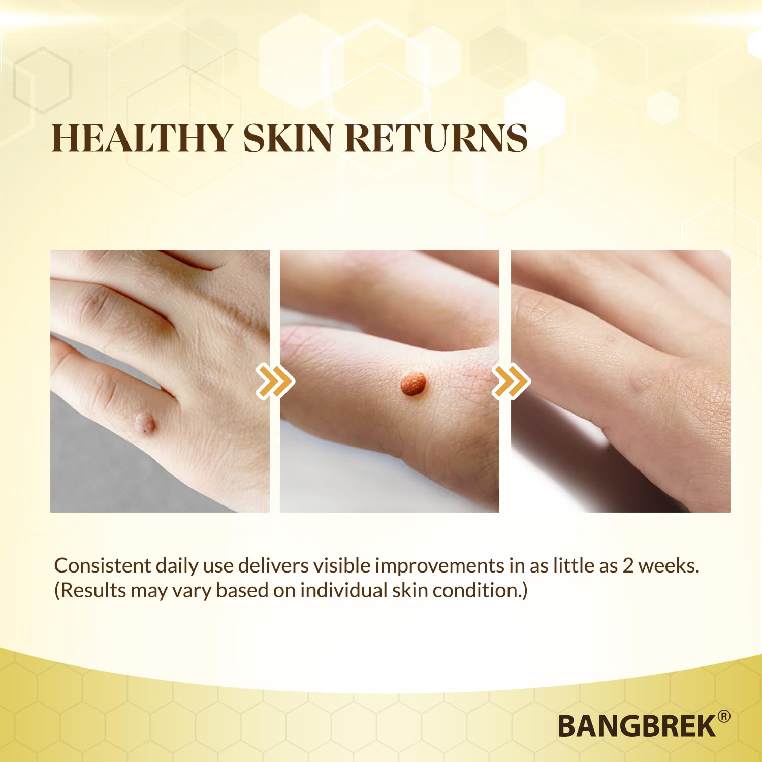Bangbrek Bee Venom Wart Remover — 17% Salicylic Acid Fast-Acting Wart & Callus Remover (1 fl oz)
