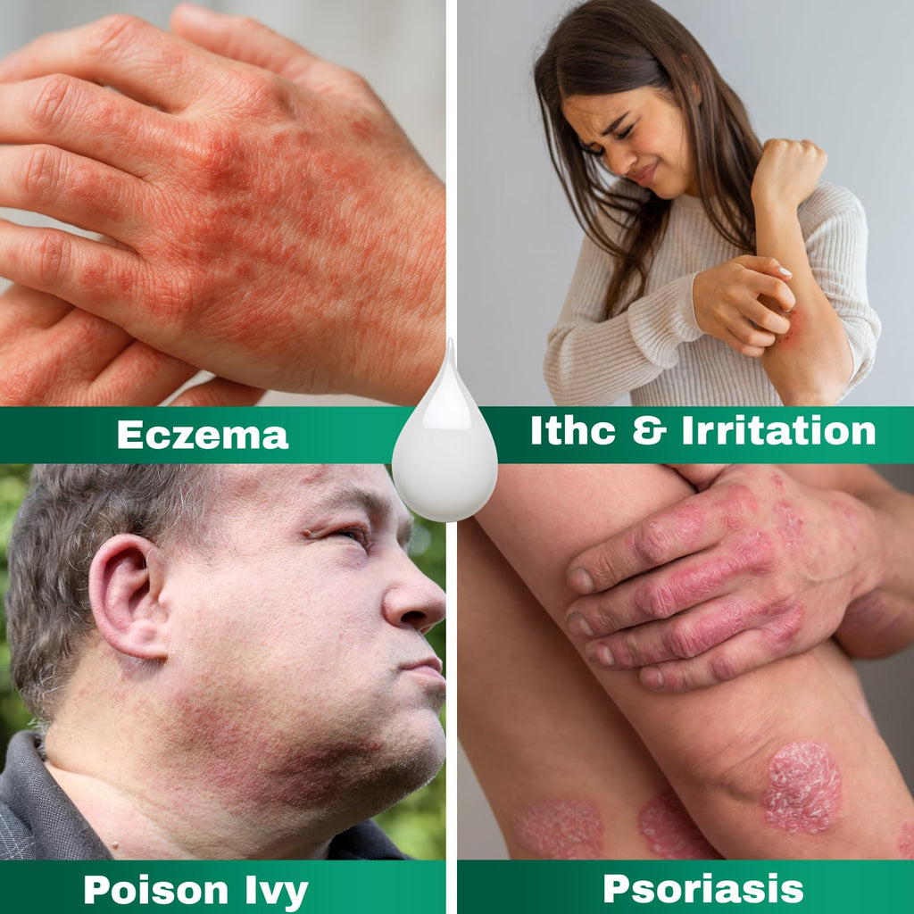 Barmicil Plus Cream 1% Hydrocortisone – Itch Relief for Skin Allergies with Aloe Vera