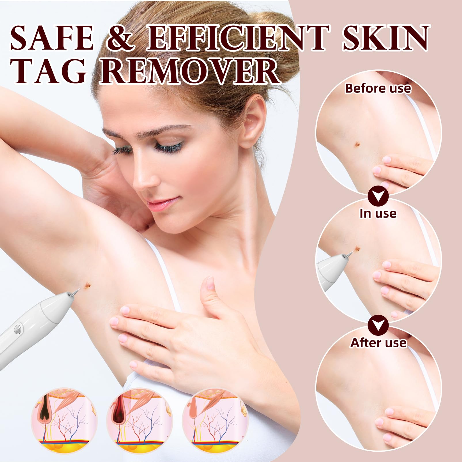 Breaspec LM 1000 SkinTag Remover - At-Home Wart & Skin Tag Kit