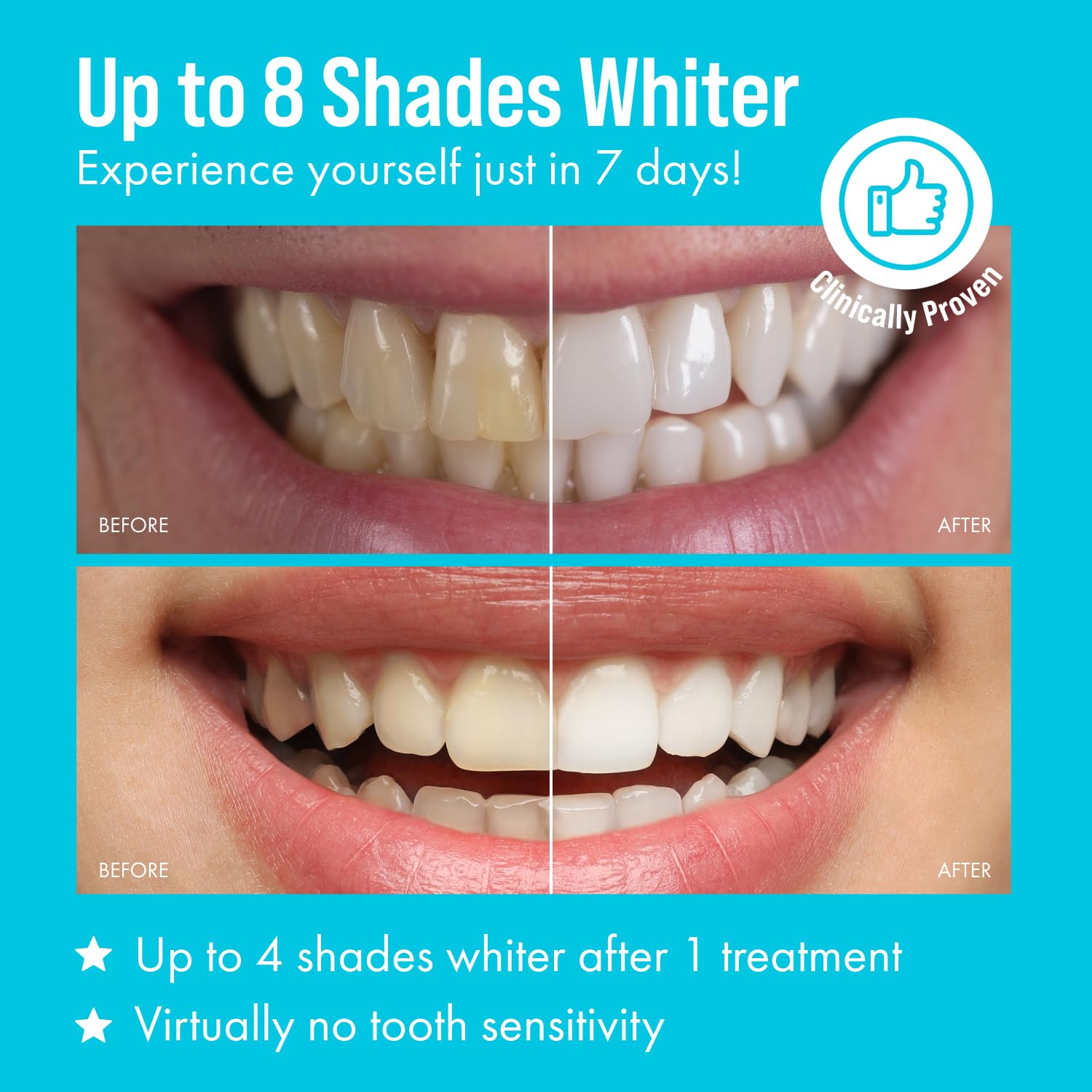 Cali White Teeth Whitening Kit with LED Light – 2x5ml Syringes & Trays