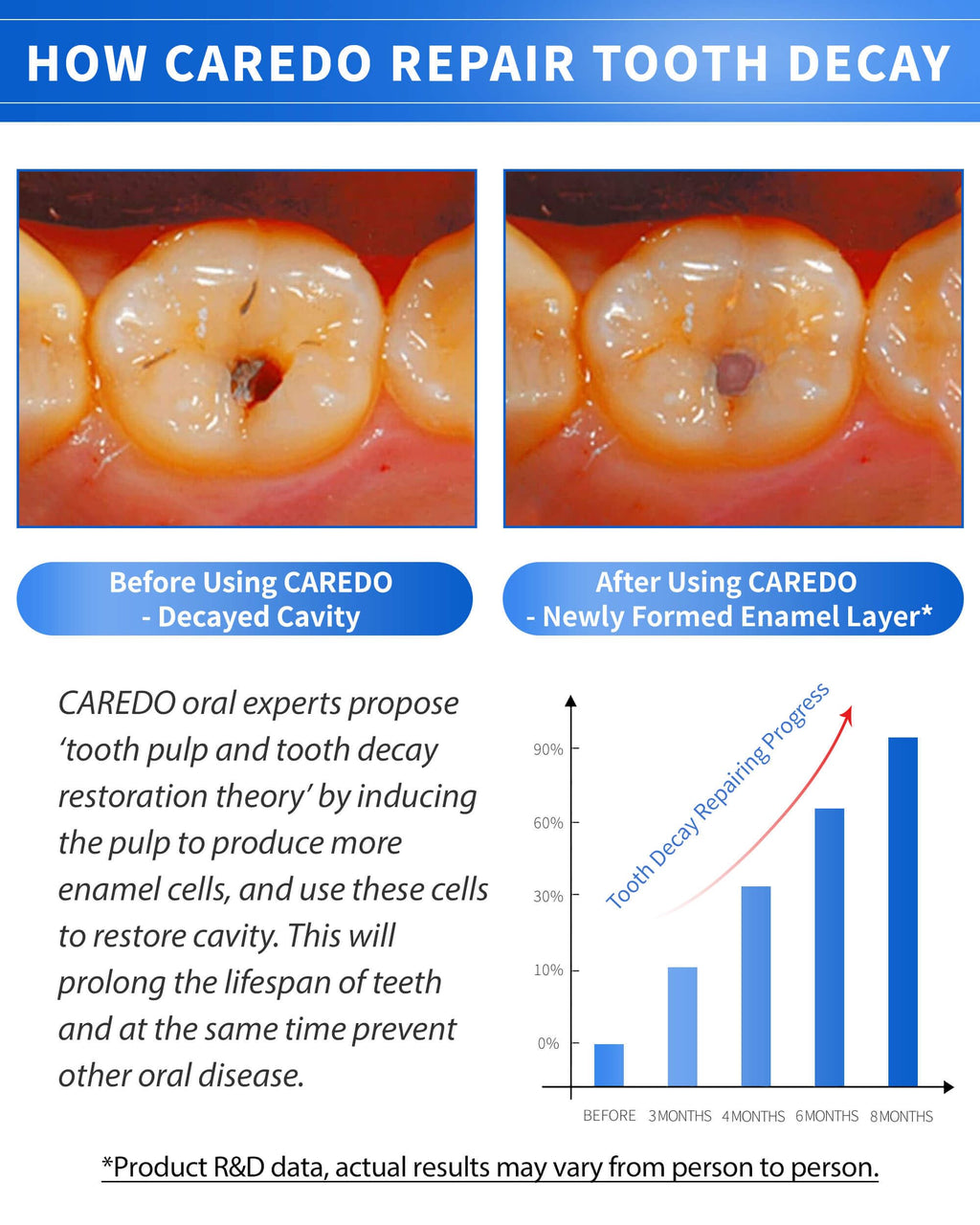 CAREDO Cavity Repair Toothpaste Set – 100g Hydroxyapatite + 16g Pulpitis Ointment