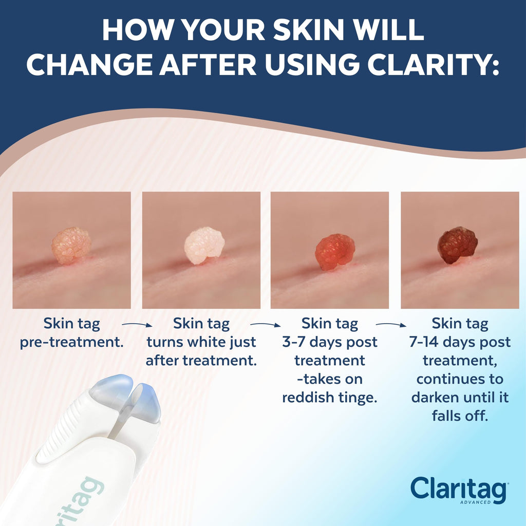 Claritag Advanced Skin Tag Remover - FDA-Cleared At-Home Skin Tag Removal (7-14 Days)