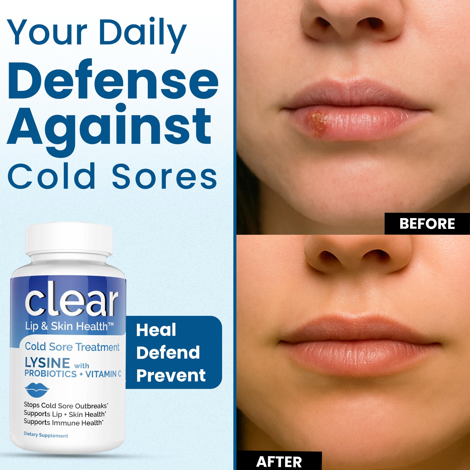 Clear Probiotics Lysine Cold Sore Treatment for Lips – Probiotic Lysine + Vitamin C – 180 Capsules