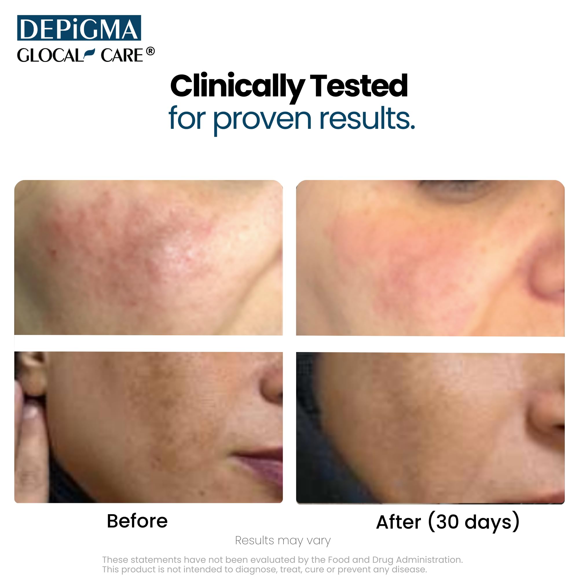 GlocalCare Depigma Support Reduction of Hyperpigmentation, Melasma & Dark Spots with Glutathione, Polypodium Leucotomos, Grape Seed & Marigold Extract
