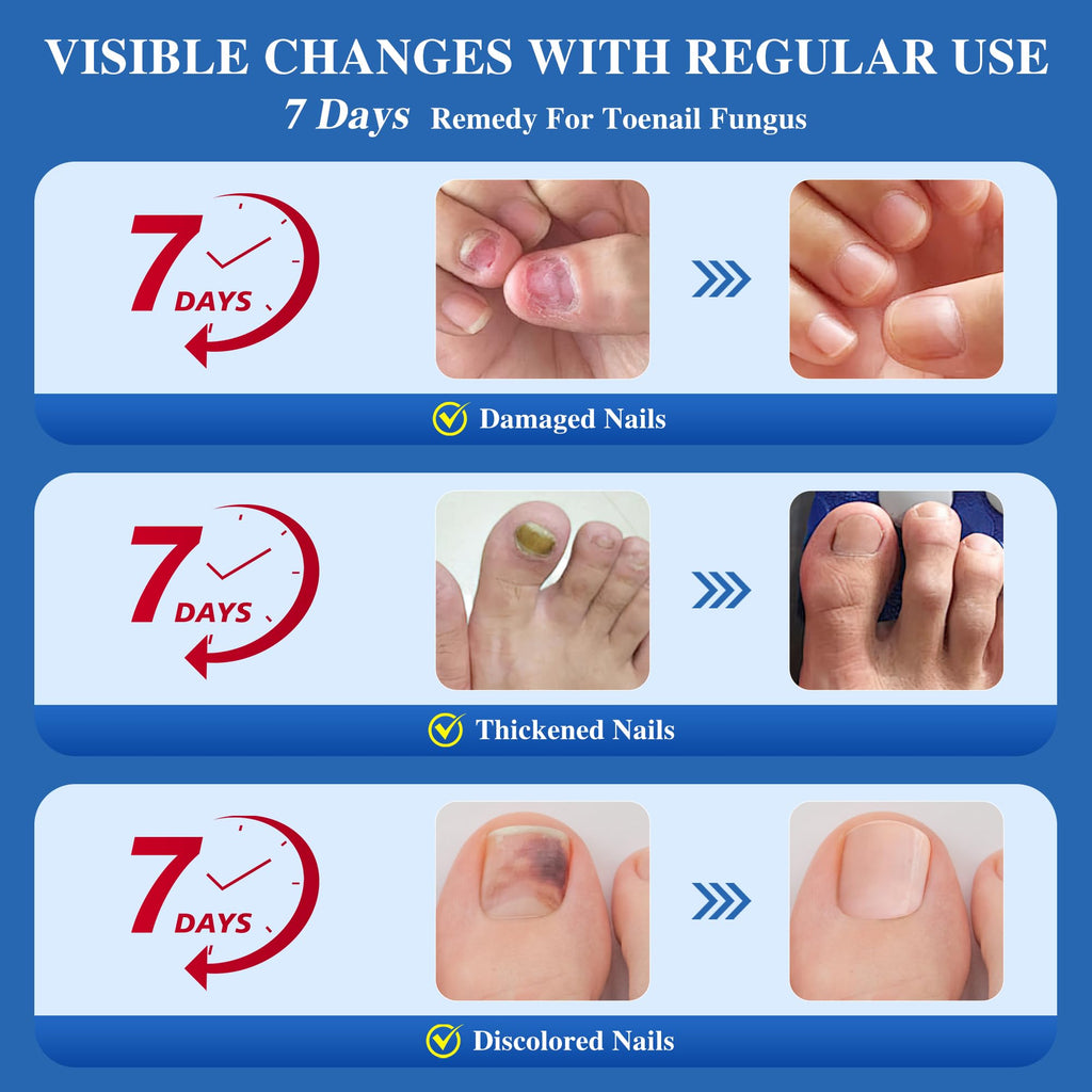 DR.RAPID Toenail Fungus Treatment Extra Strength - Fast-Acting Nail Repair with Tea Tree Oil