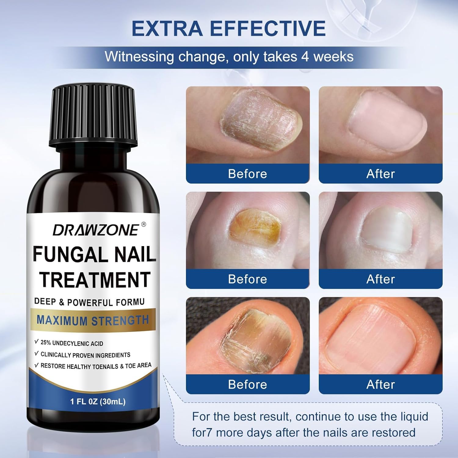 Drawzone Toenail Fungus Treatment Extra Strength – 25% Undecylenic Acid, Nail Renewal