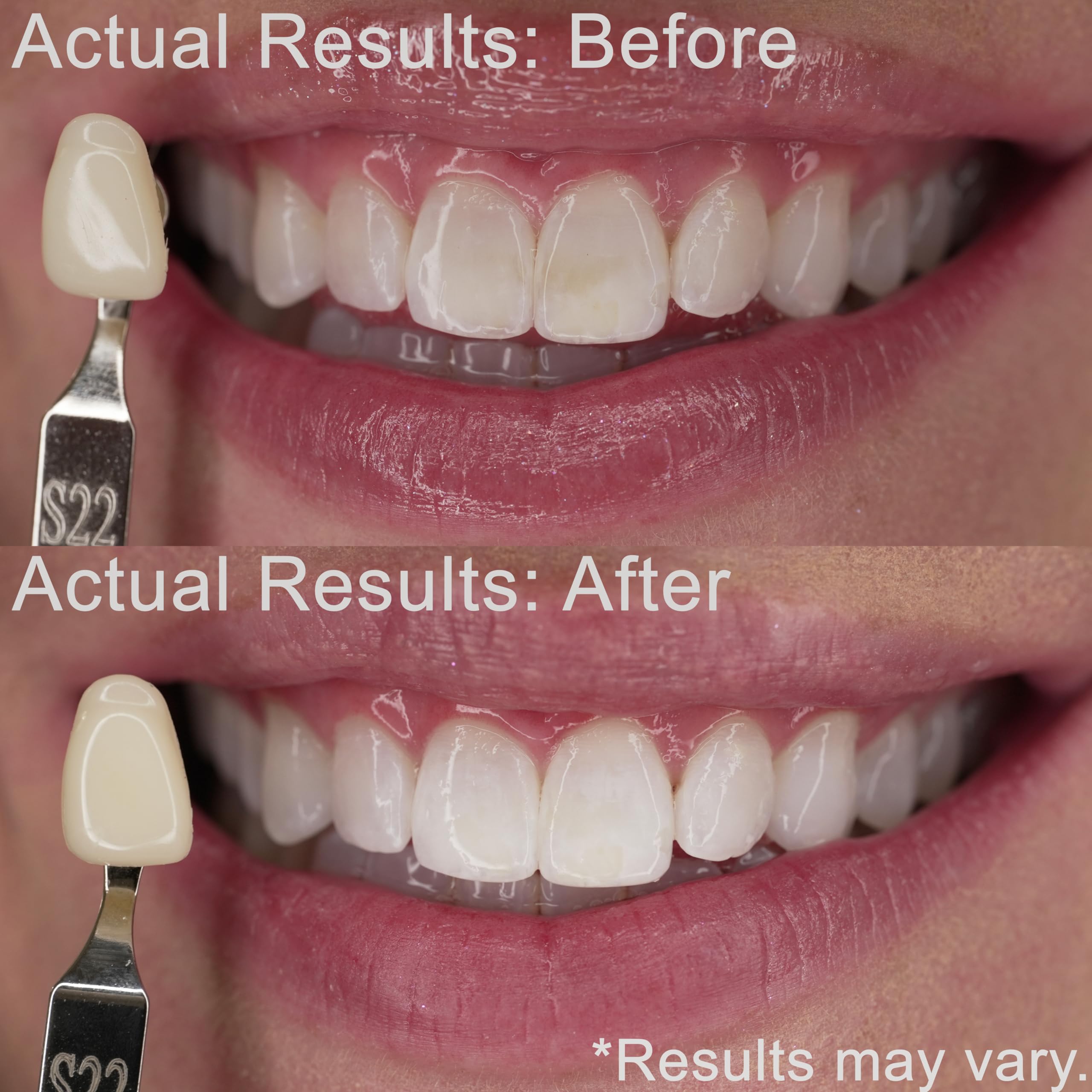 EZZI Teeth Whitening Kit - Fast 44% Carbamide Peroxide Whitening for Discolored Teeth and Intrinsic Stains