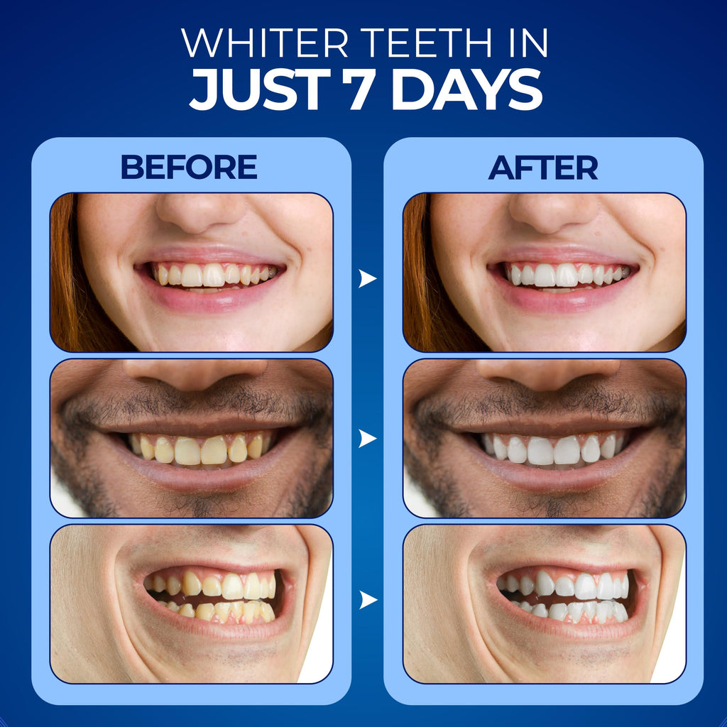 Euphauria Home Teeth Whitening Kit with LED Light - 3 Gel Pens, No Sensitivity