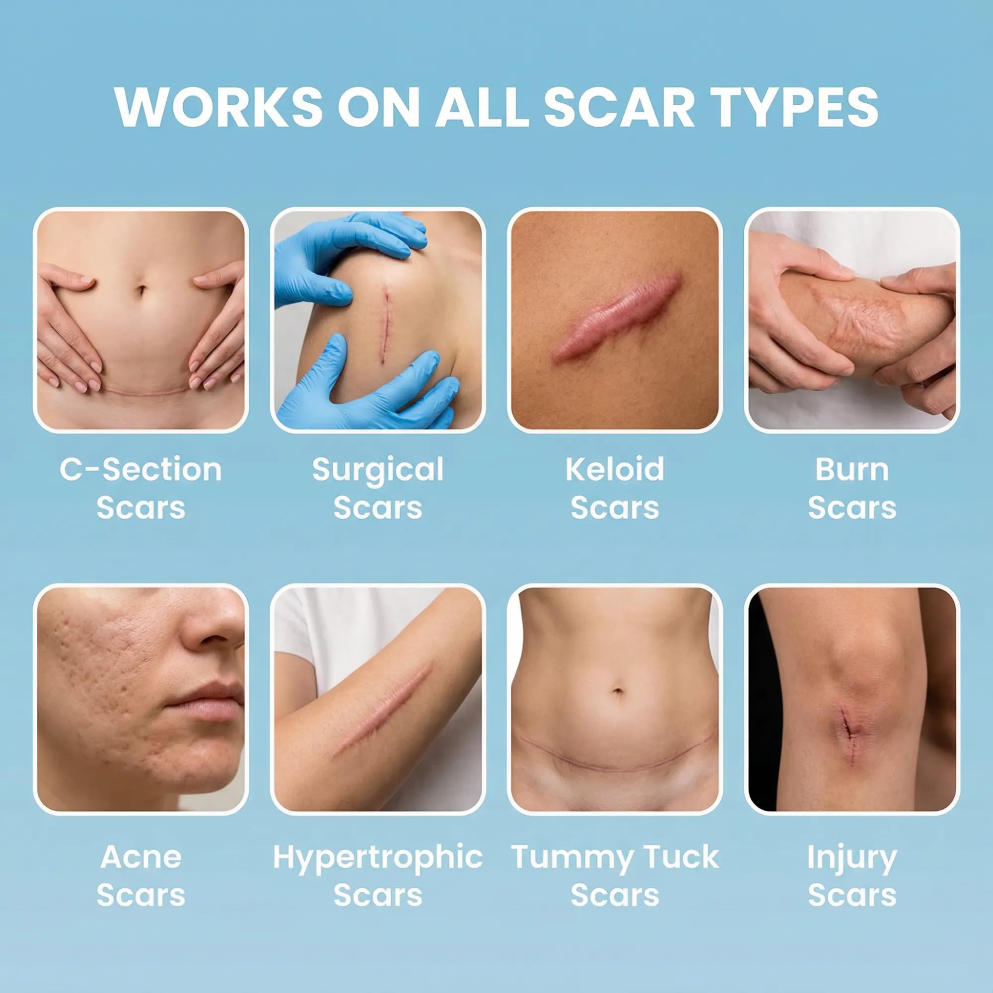 Eva Naturals Medical Grade Silicone Scar Tape 1.6in x 120in - Reusable Sheets for C-Section, Surgical, Keloid & Burn Scars