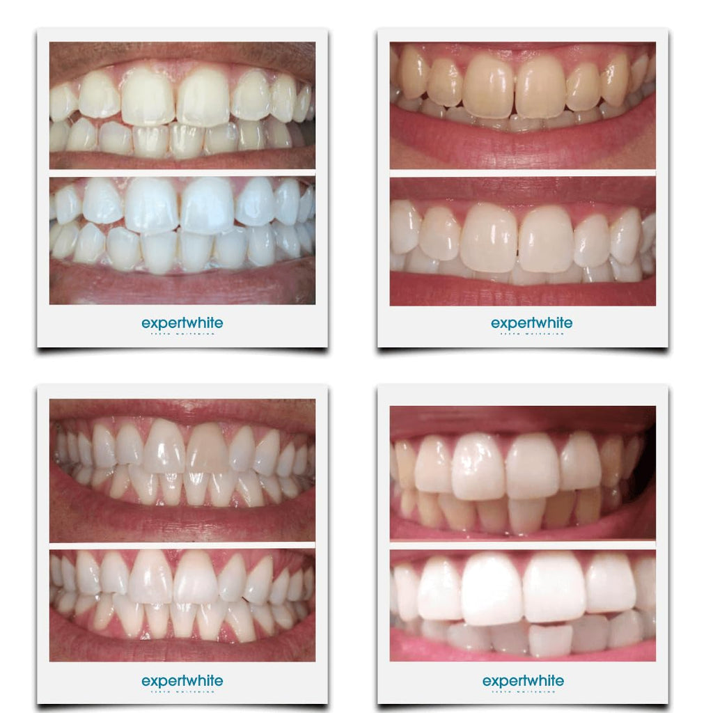 Expertwhite 44% Carbamide Peroxide Teeth Whitening Gel Refills for Trays – 4 x 3cc (15 Minutes)
