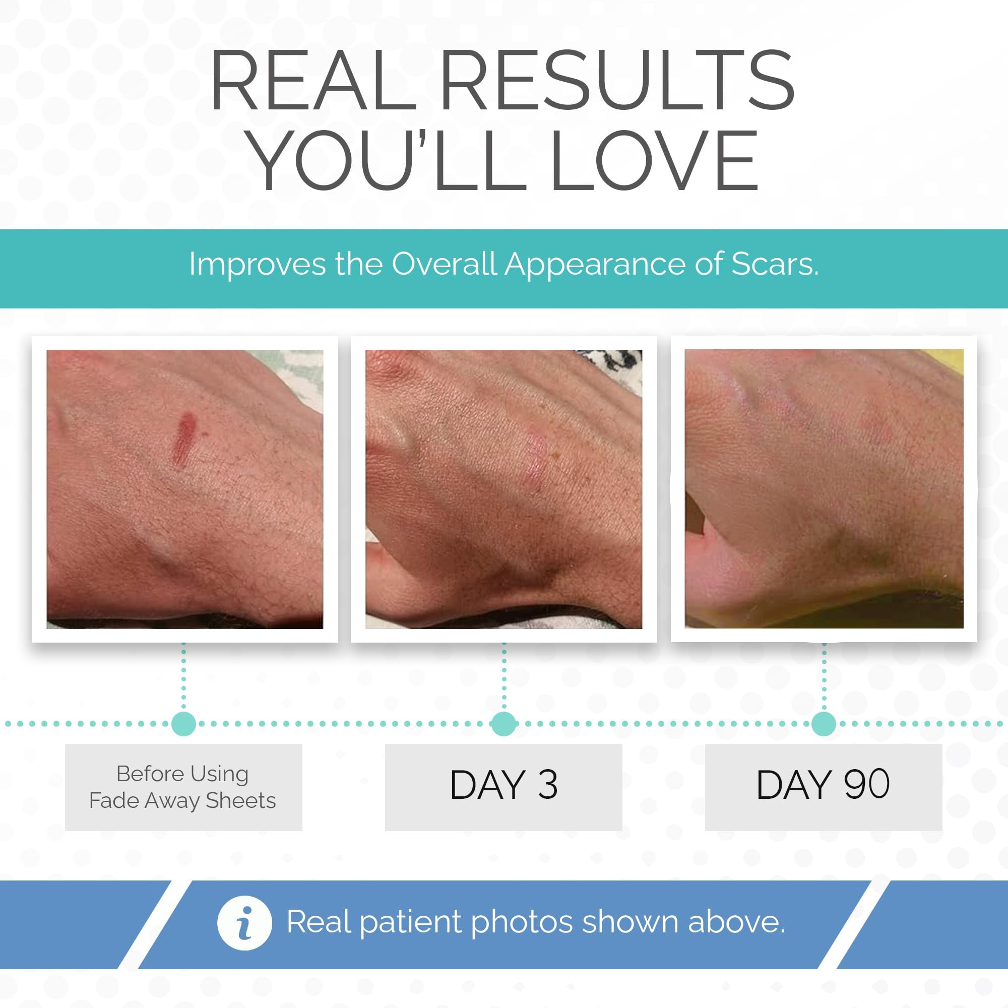 Fade Away Clinically Proven Silicone Scar Sheets – Medical Grade Tape for Surgery, C-Section, Keloids & Tummy Tuck Scars