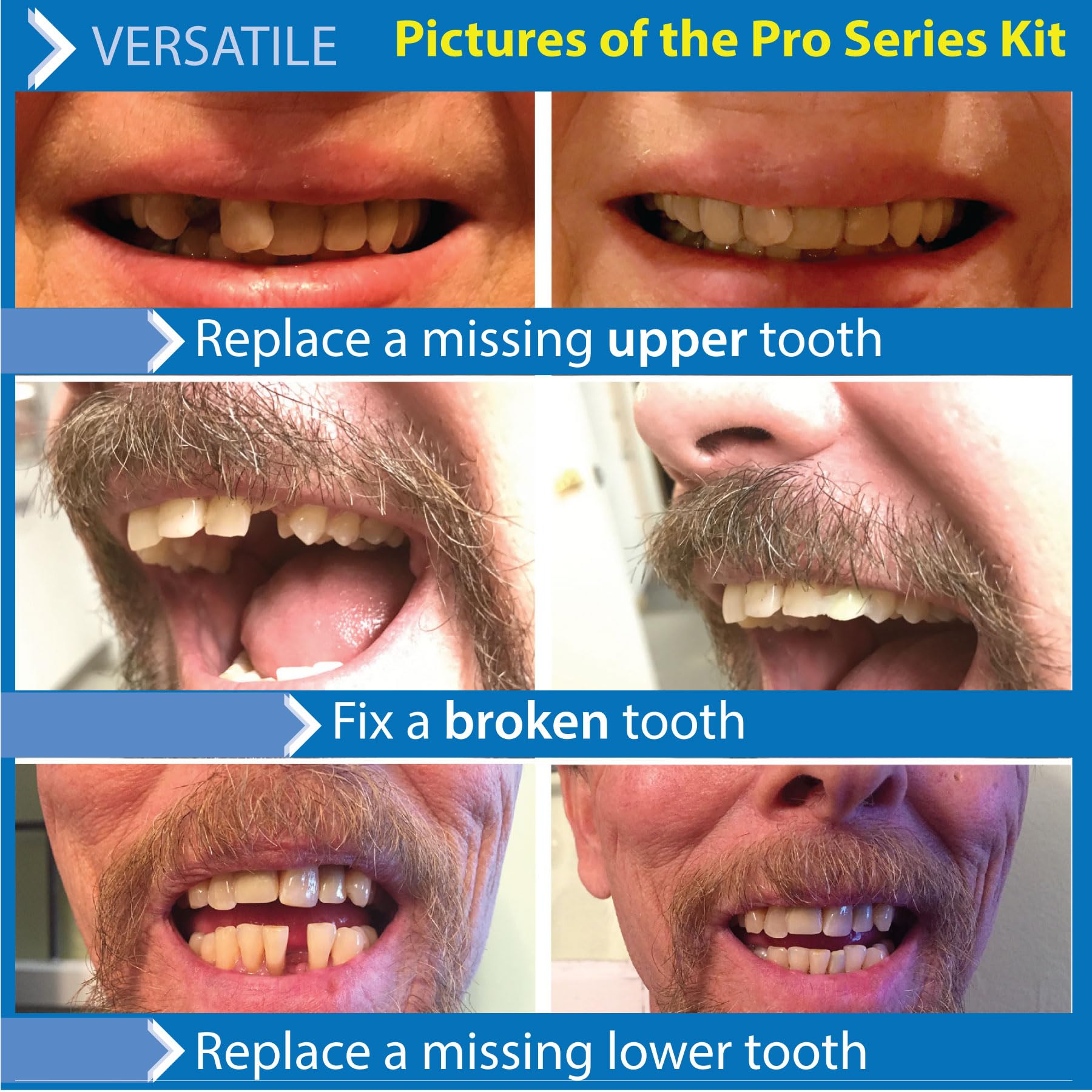 Instant Smile Pro Series Temporary Tooth Kit – At-Home Replacement