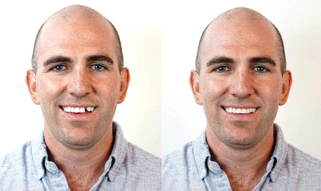 Instant Smile Triple Shade Temporary Tooth Kit - Replace a Missing Tooth in 5 Minutes