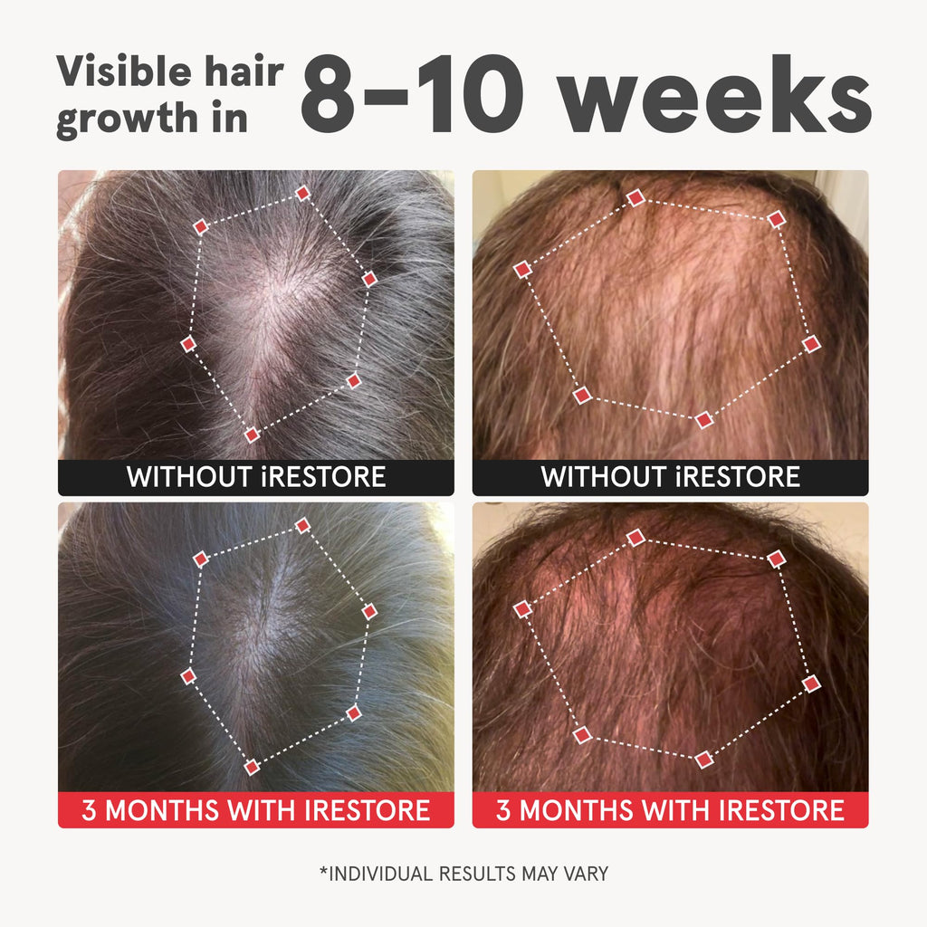 iRestore Advanced Hair Growth Supplement for Women — 30 Count (Pack of 3)