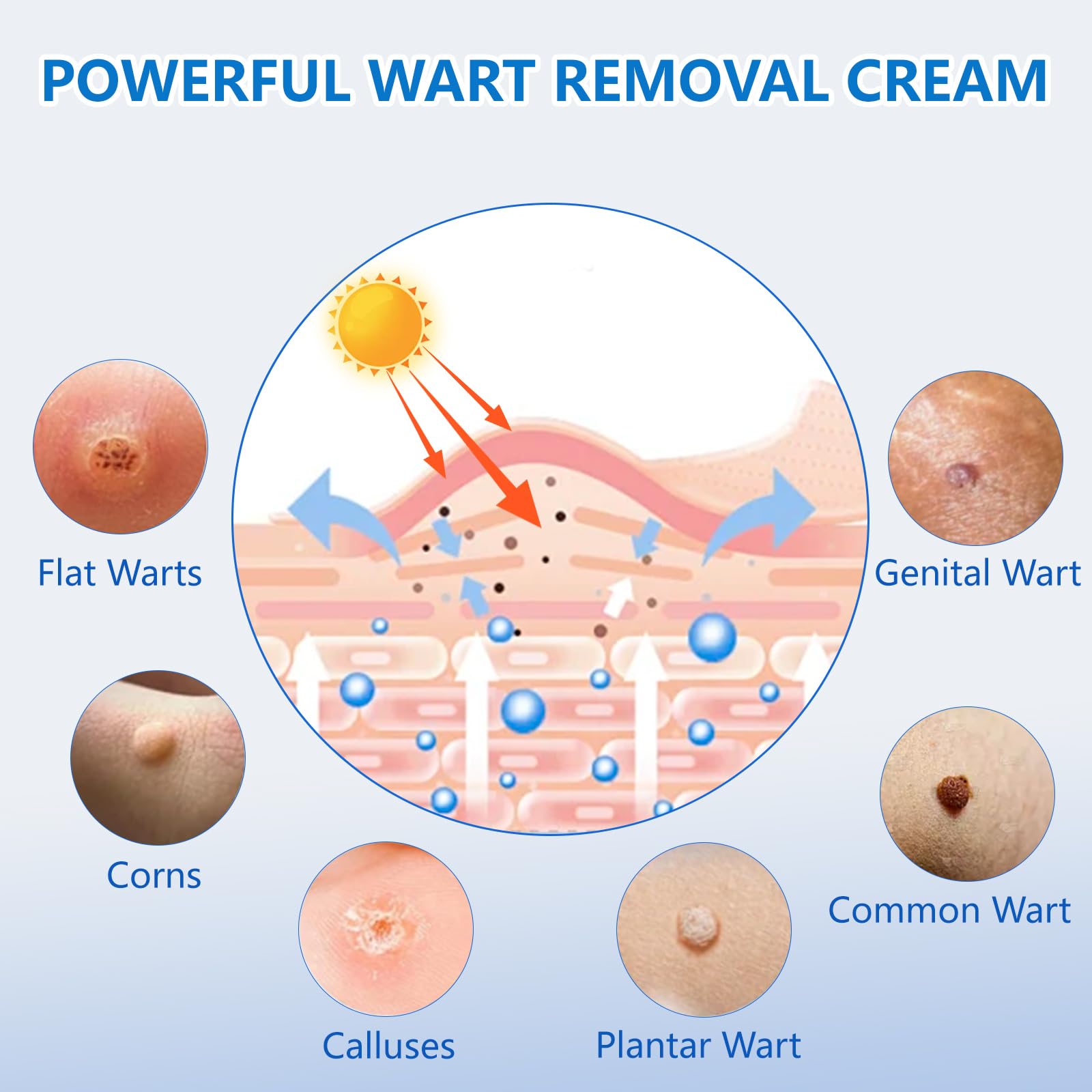 KIbabyDI Wart Remover Gel – Fast Acting Freeze Treatment for Genital, Plantar, Common, Corn & Flat Warts (1 Pack, Red 10101)