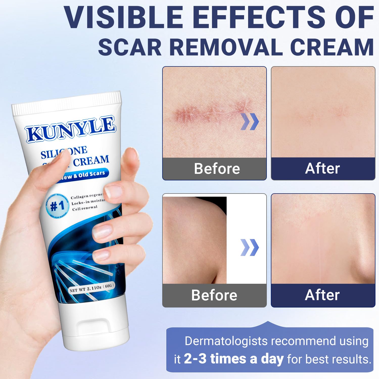 Kunyle Scar Cream | Silicone Scar Gel for Surgical Scars, Keloids & Stretch Marks | 60g