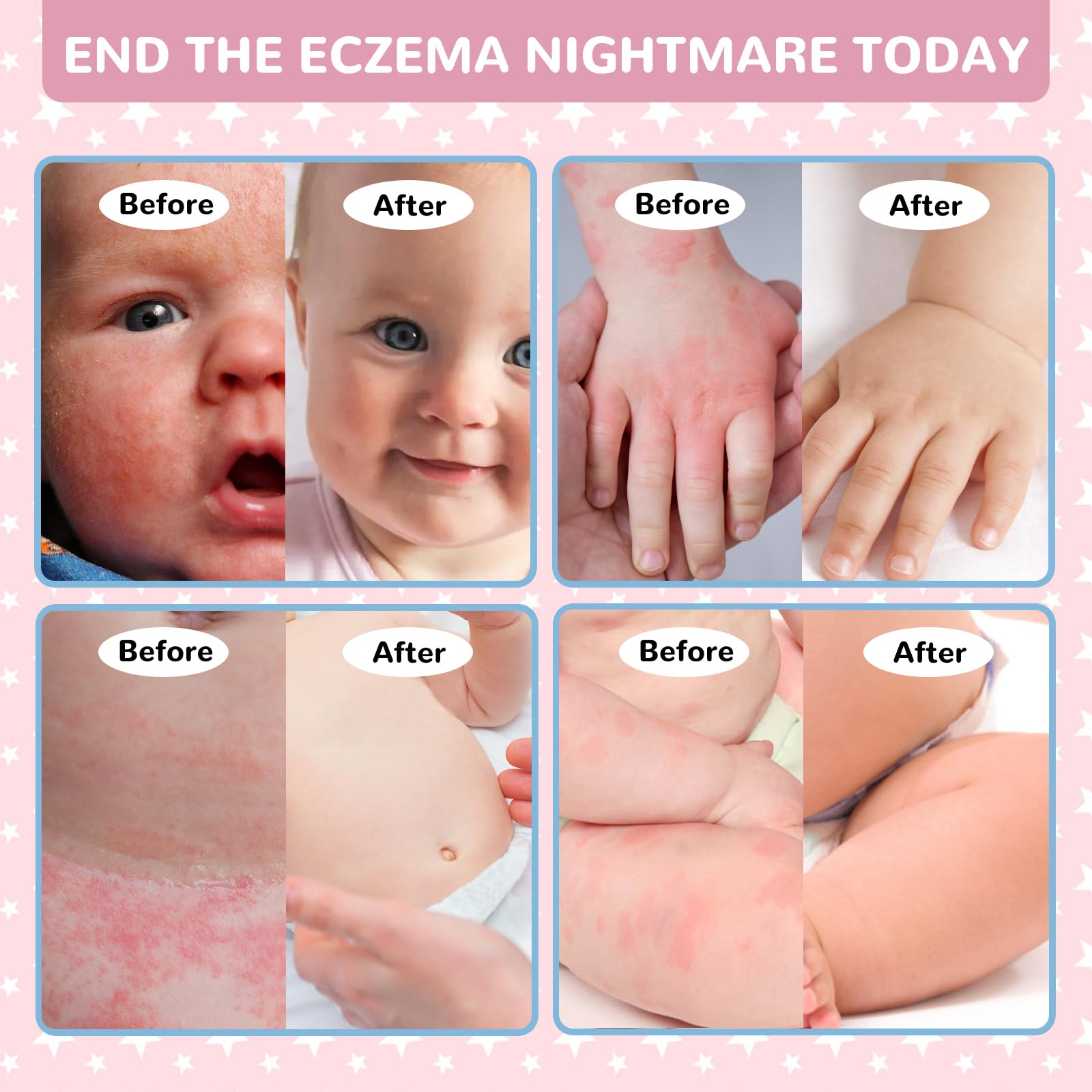 LMNOOP Baby Eczema Relief Cream | All-Natural Herbal Formula 3.53oz