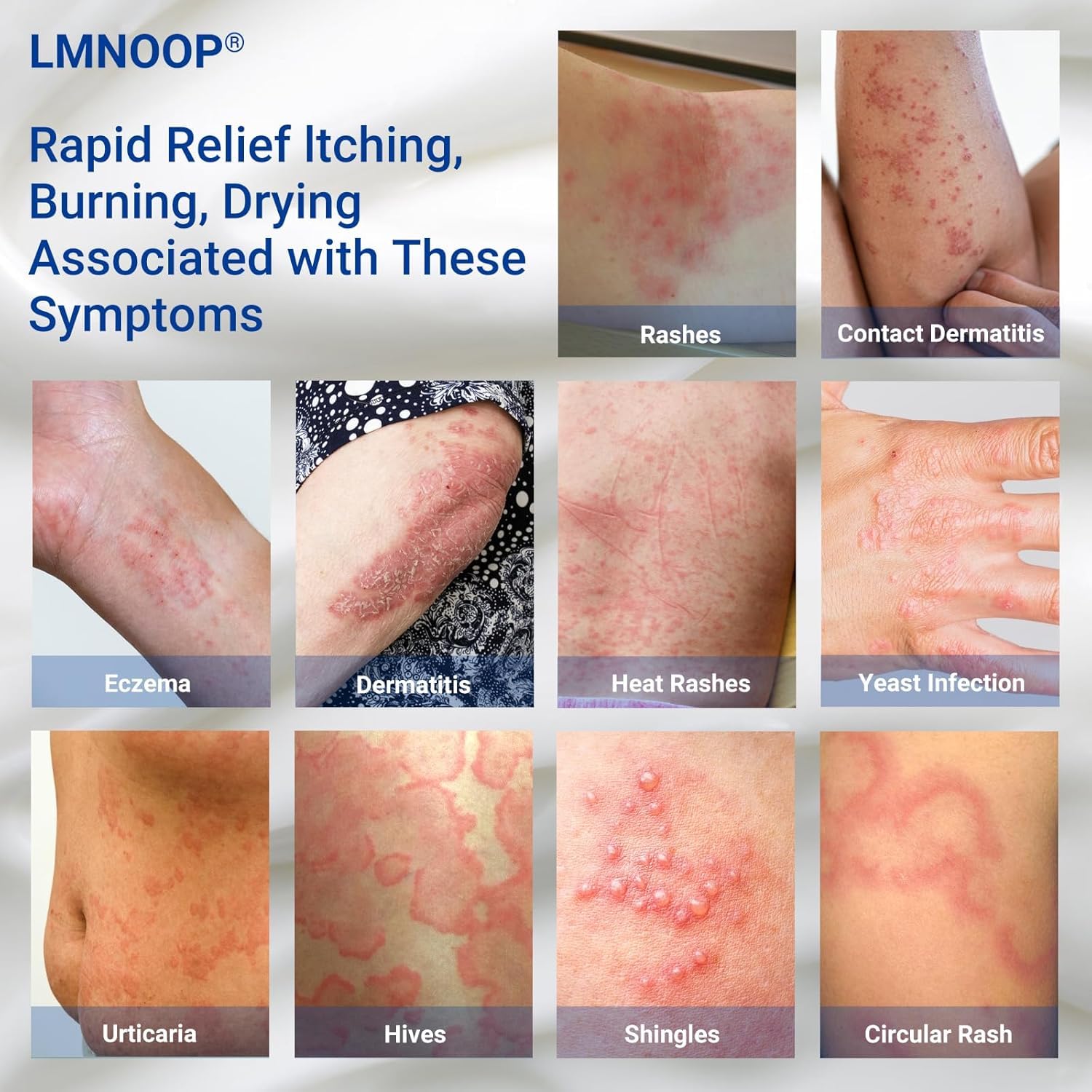 LMNOOP Eczema Cream – Maximum Strength Treatment for Dry, Itchy, Irritated Skin (3.53oz)