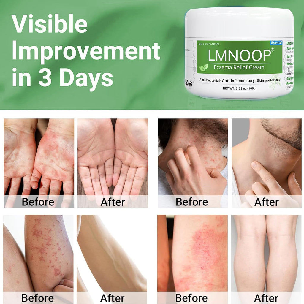 LMNOOP Eczema Cream — Maximum Strength Itch Relief for Dry, Irritated Skin (3.53oz)