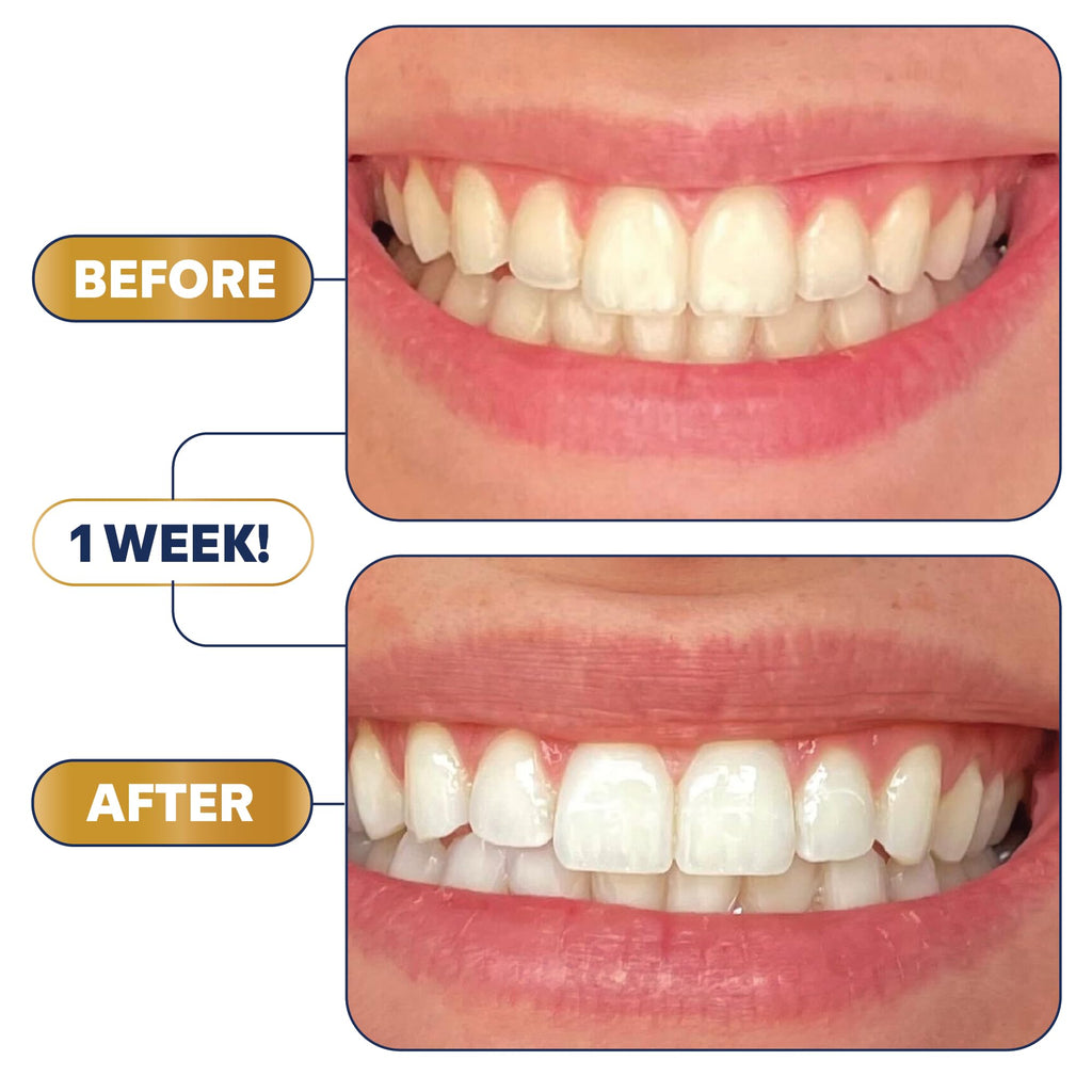 Lumineux Longevity Whitening Kit Bundle – 6 Toothpastes, 6 Mouthwashes, 2 Strips, 2 Pens | Enamel-Safe & Clinically Proven