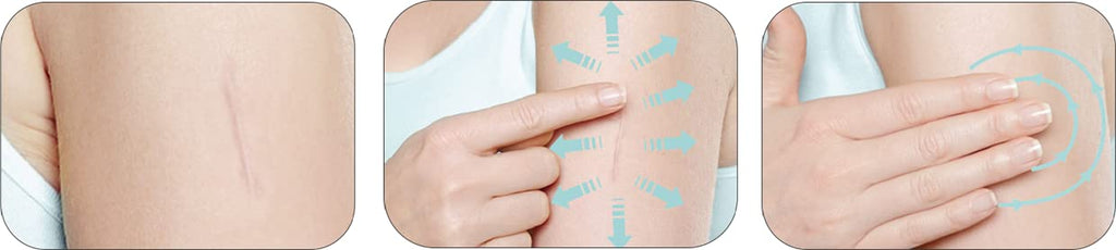 Mederma Skin Care for Scars — Safe, Doctor-Recommended Scar Treatment