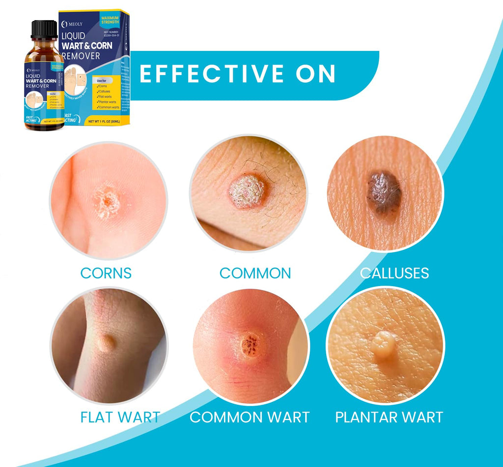 MEOLY Salicylic Wart Removal Freeze Away – Fast-Acting Maximum Strength Wart Remover (30 ml)