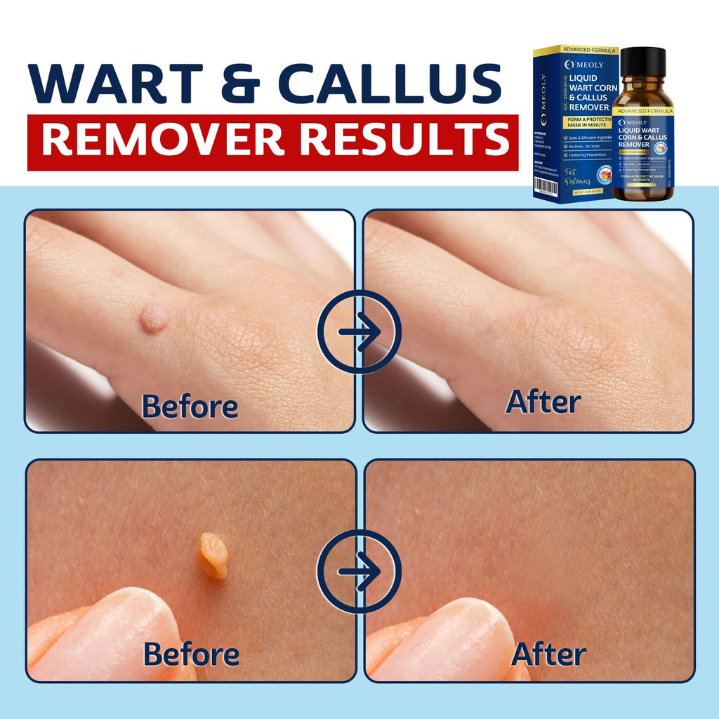 MEOLY Fast-Acting Wart Remover Freeze Off – Plantar Warts, Corns & Calluses, 30 ml
