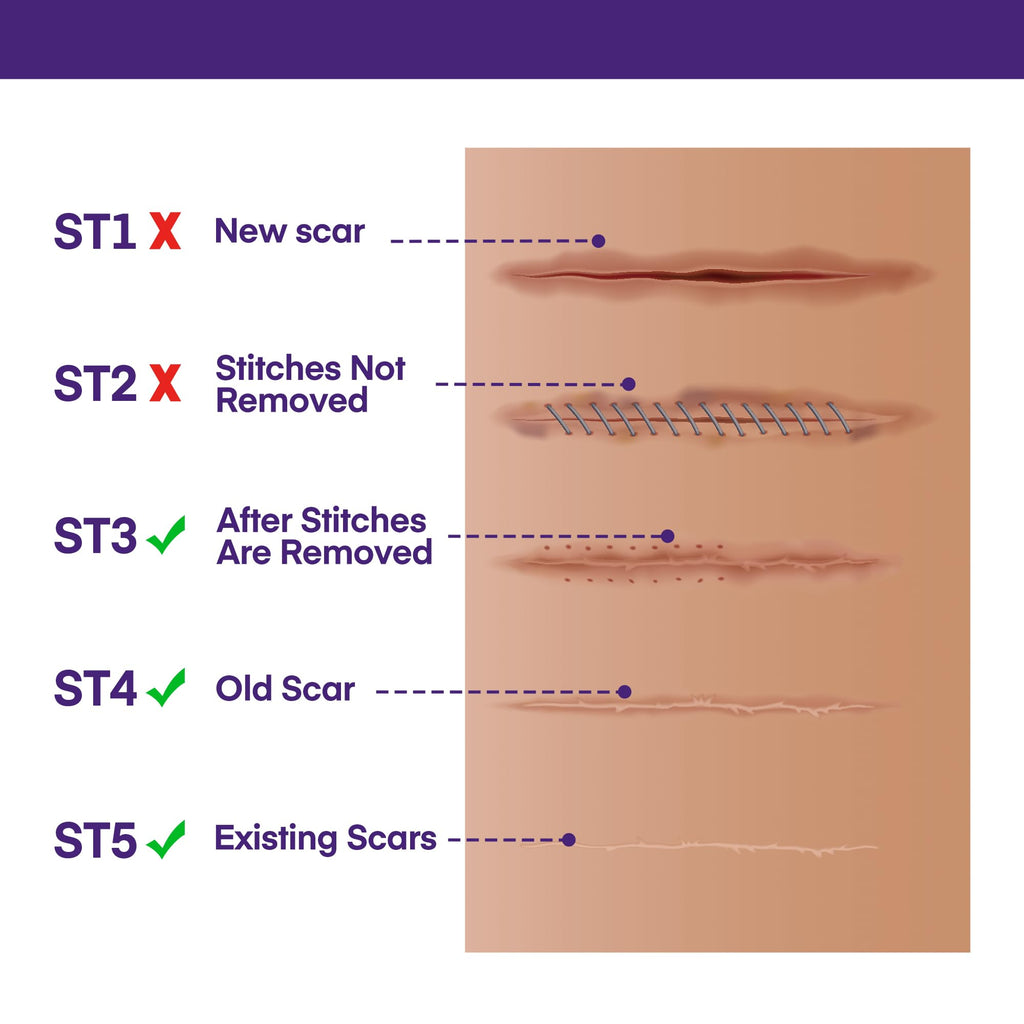 MURASAKI BEAUTY Silicone Scar Gel SPF 30 – Medical-Grade Scar Cream (1.06oz)