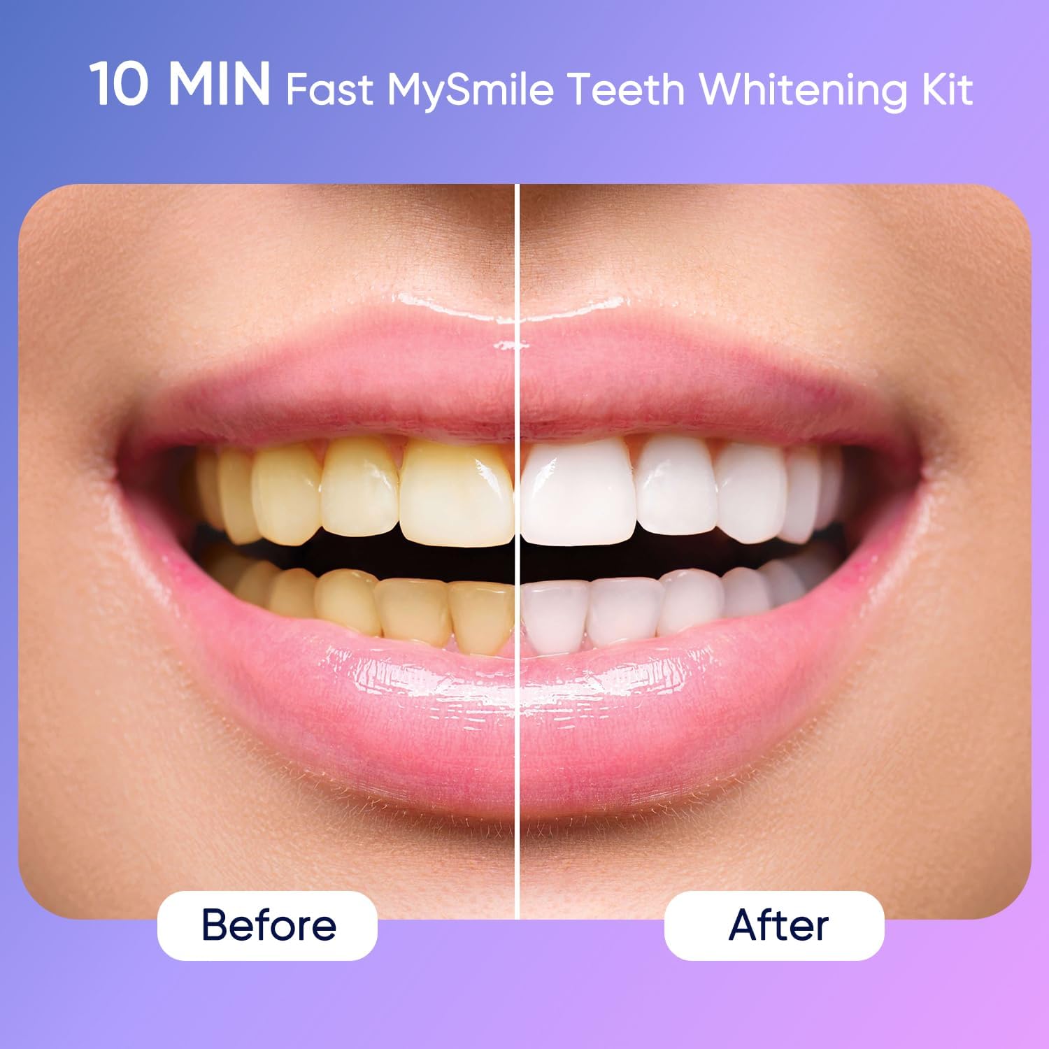 MySmile Deluxe 10 Min Teeth Whitening Kit – 28 LED, 35% Carbamide Peroxide