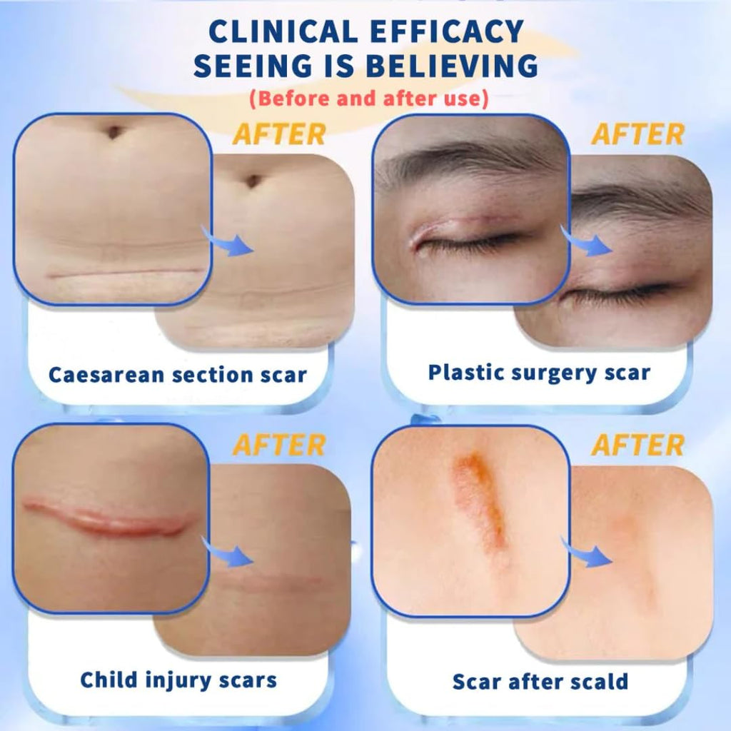 NOUVOS Dermatix Ultra Scar Gel - 15g | Softens and Flattens Scars, Quick-Drying, Odorless