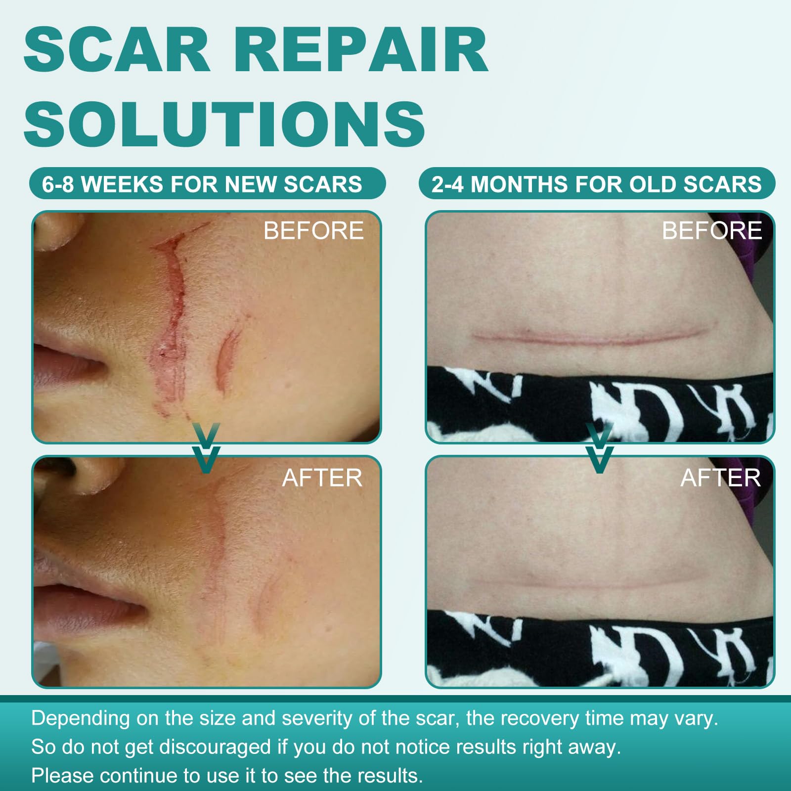 Nullam Silicone Scar Sheets & Tape Roll (1.6 x 59 in) for Surgical, C-Section & Keloid Scars