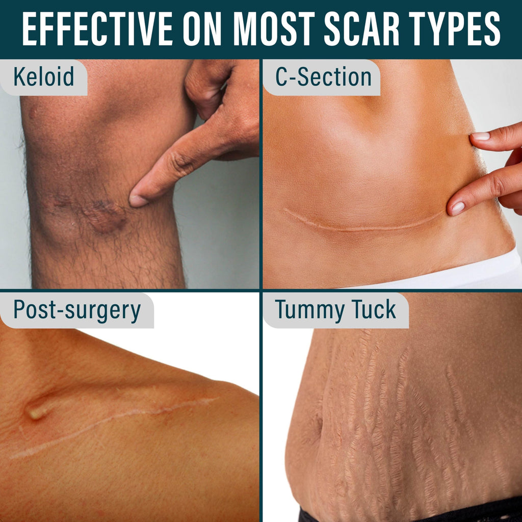 NUVADERMIS Silicone Scar Sheets - 120x1-5 Roll - Medical-Grade Scar Tape for Surgical Scars Wrinkles and Keloids