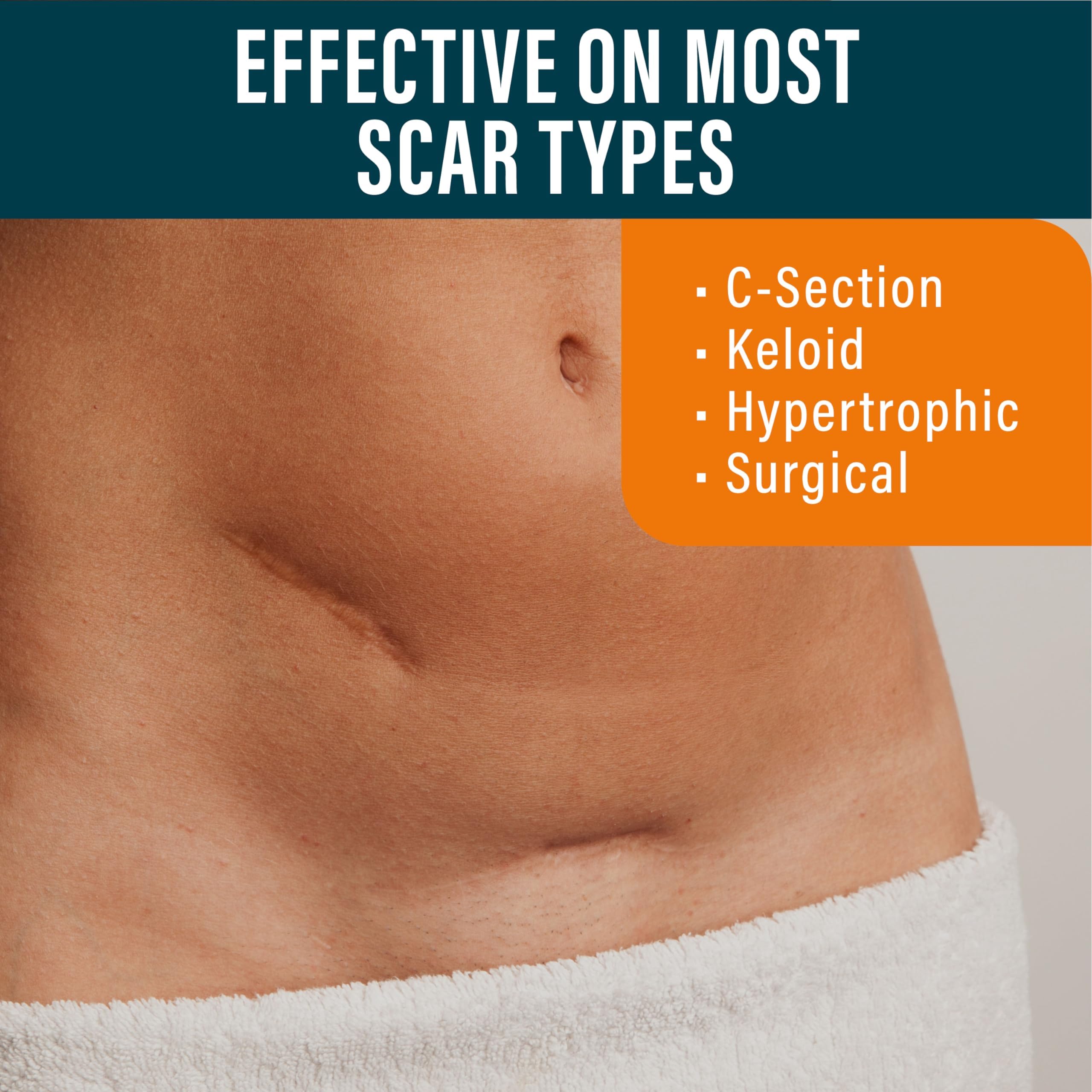 NUVADERMIS Silicone Scar Sheets - Extra Long, Reusable Medical-Grade for C-Section, Tummy Tuck & Surgical Scars