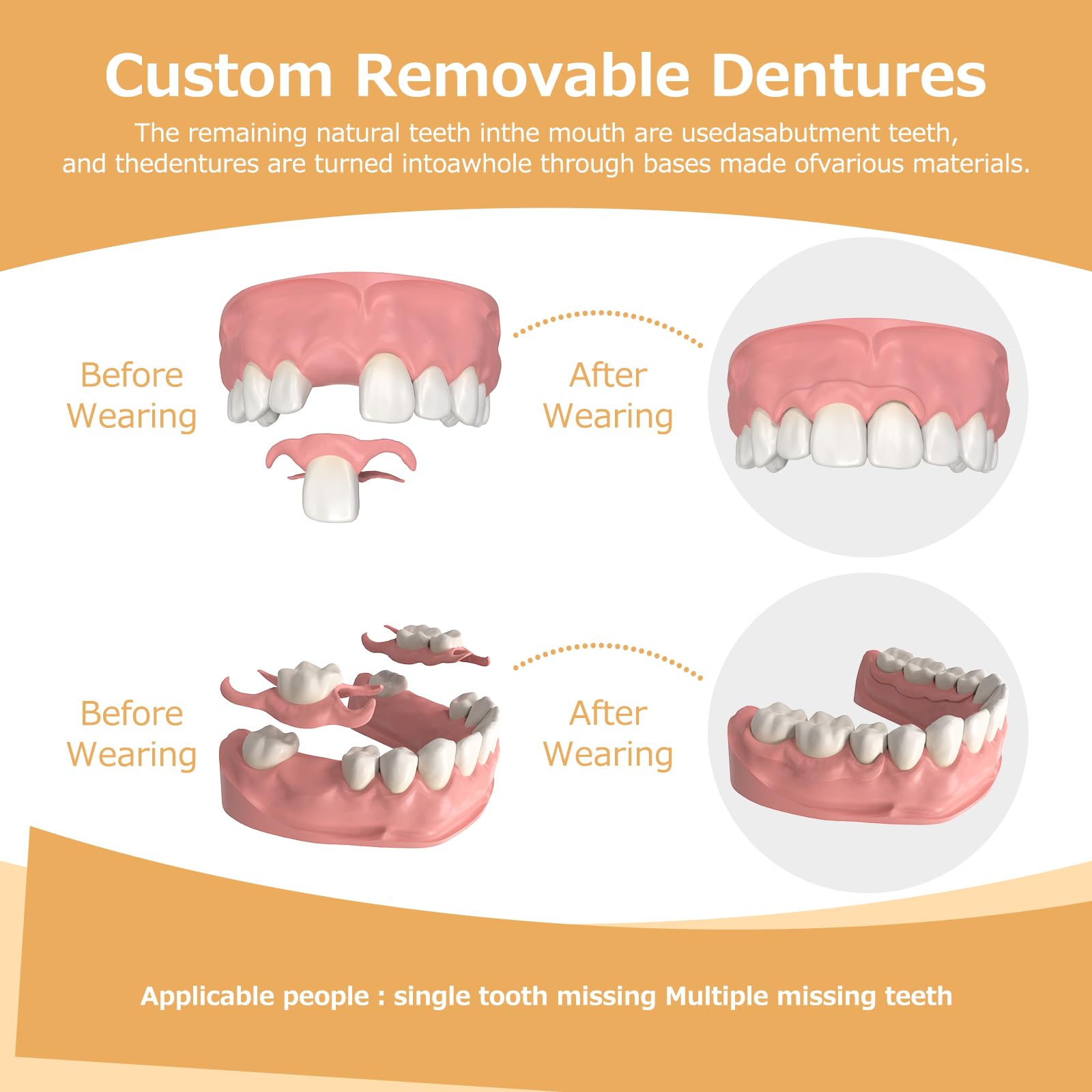 Partial Dentures for Missing Teeth & Gaps — Lightweight, Unbreakable Replacement Teeth (1 Tooth)
