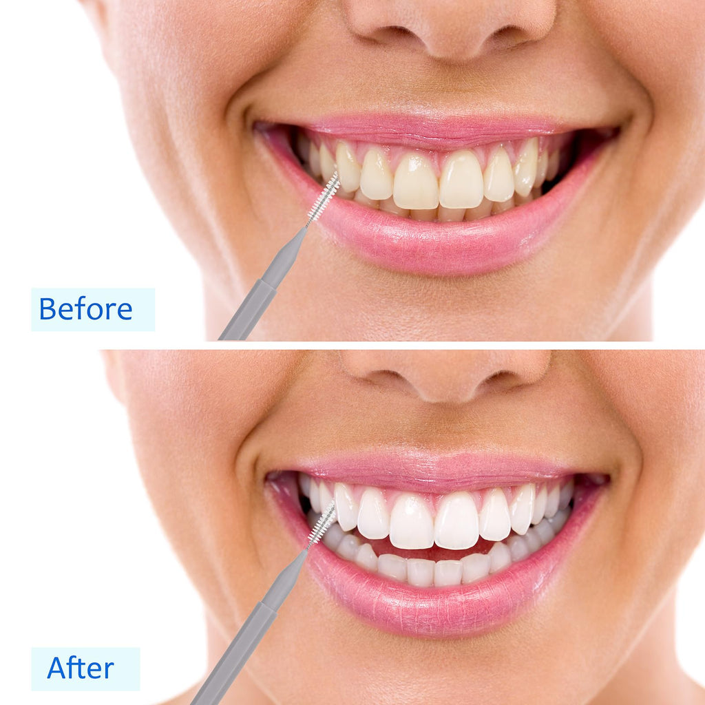 Patelai 100Pcs Braces Brush – Interdental Toothpick & Flosser Set