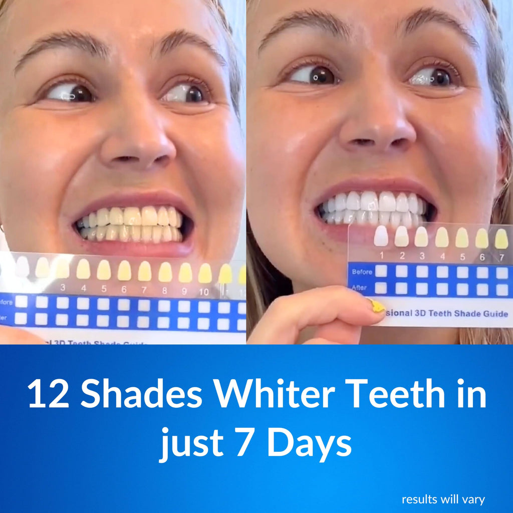 Polar MD Teeth Whitening Kit – 1 Year Supply, 60 Treatments, Gel Pens, 32 LED Light