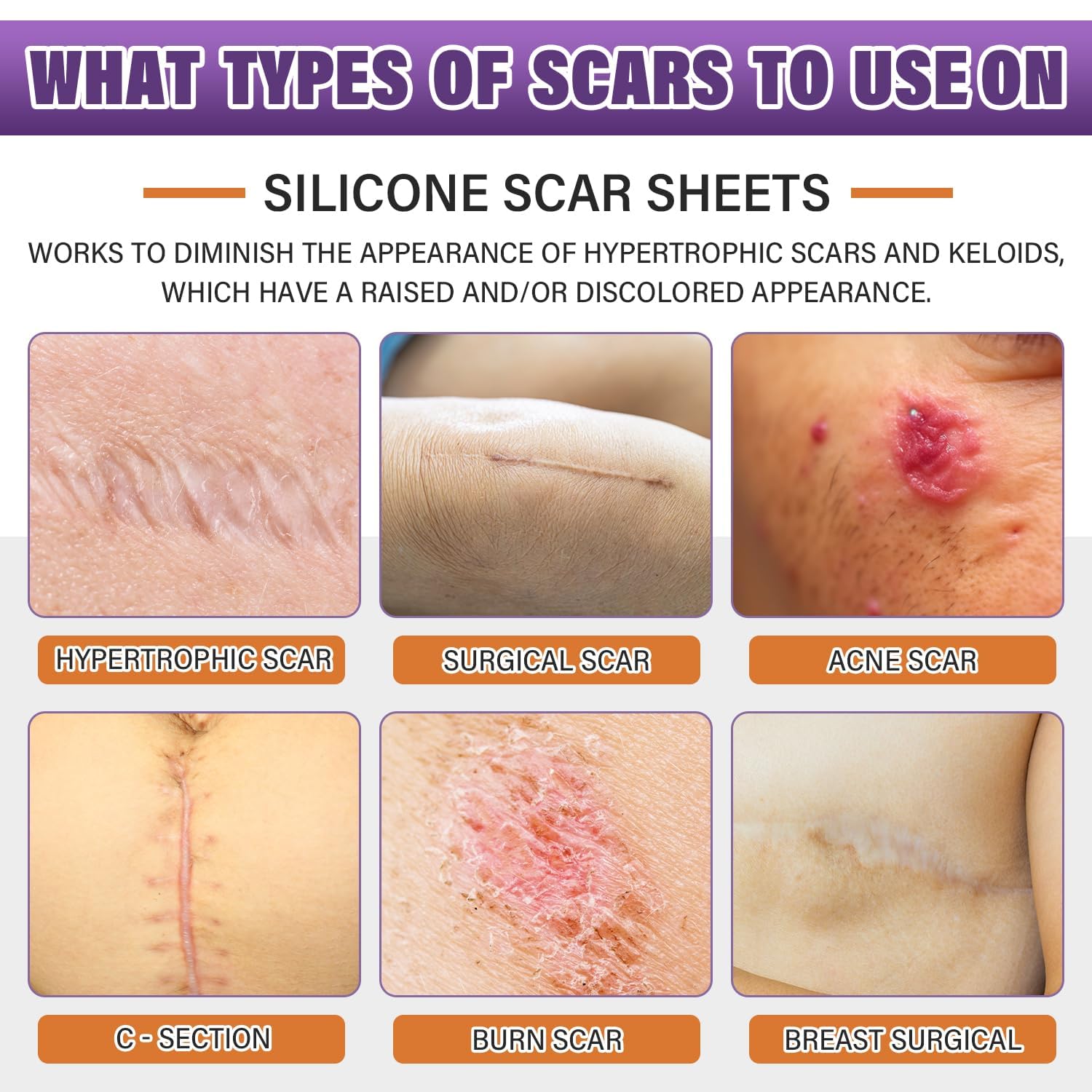 Psecici Silicone Scar Sheets & Tape – Medical-Grade, Reusable Scar Strips (1.6 x 59 in Roll)