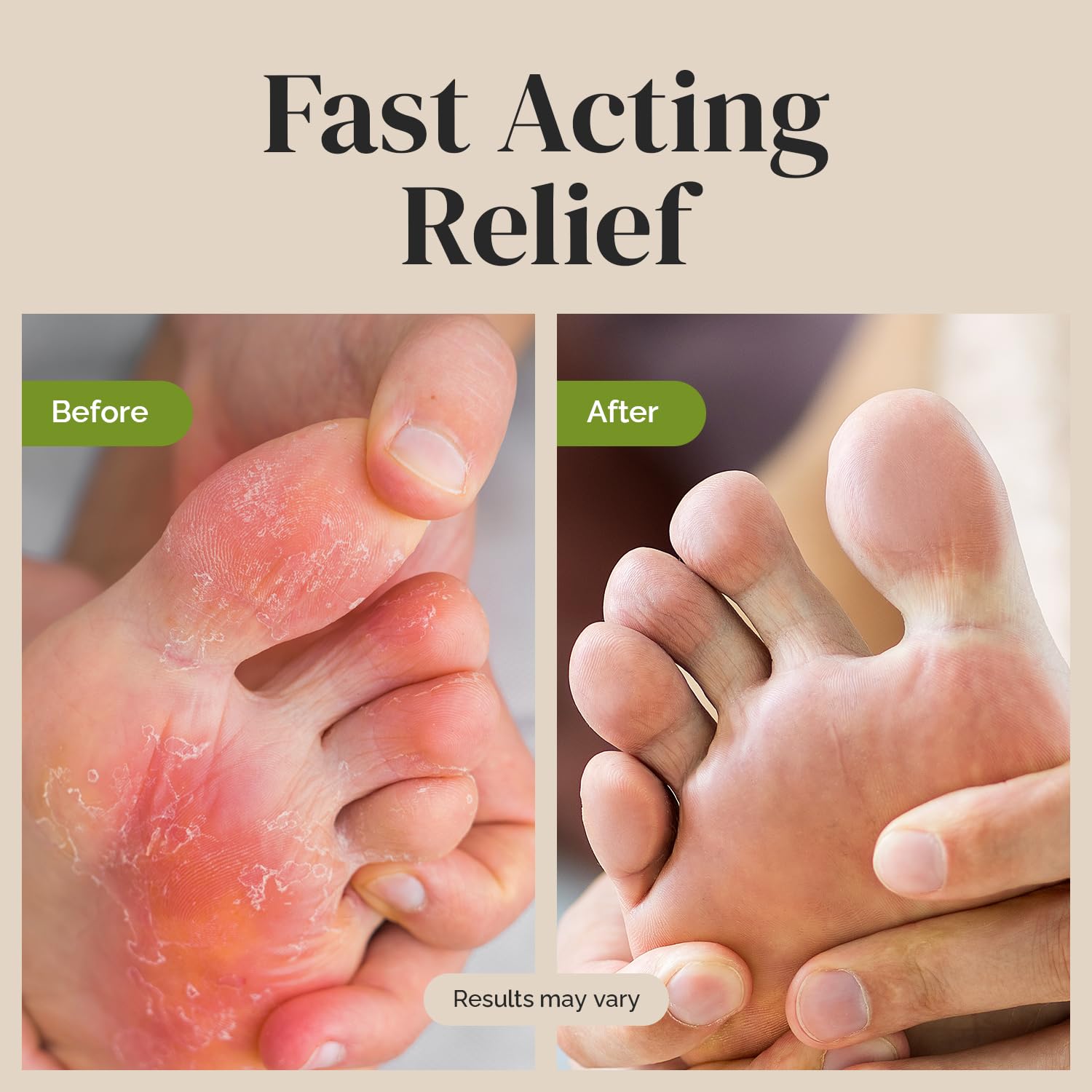 Puriya Clinically Proven Antifungal Cream for Skin Fungus – Extra-Strength Athlete's Foot, Jock Itch, Ringworm Treatment