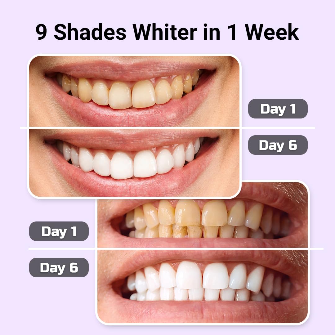 Puur Smile Teeth Whitening Kit with LED Light for Sensitive Teeth