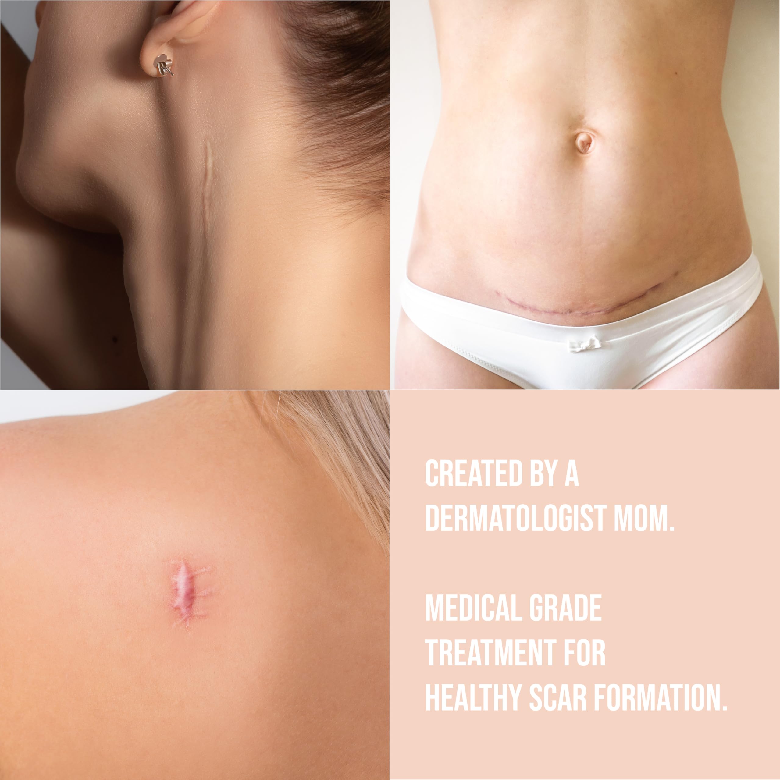 Quitch Silicone Scar Sheets – Surgical & C-Section Scar Treatment (Nude) 4x150cm