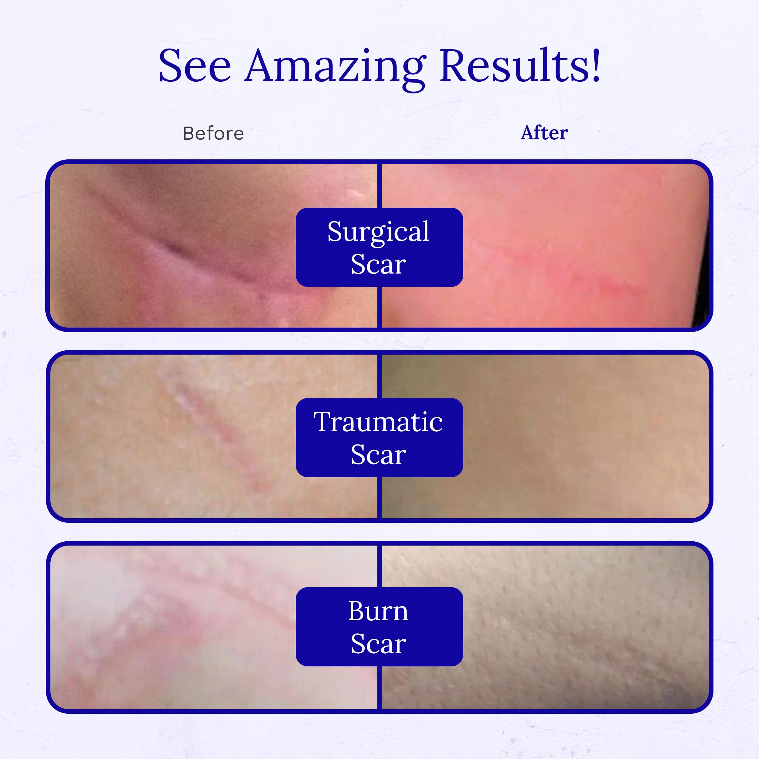 RejuvaSil Silicone Scar Gel by Rejuvaskin | Smooths Scars & Soothes Itching
