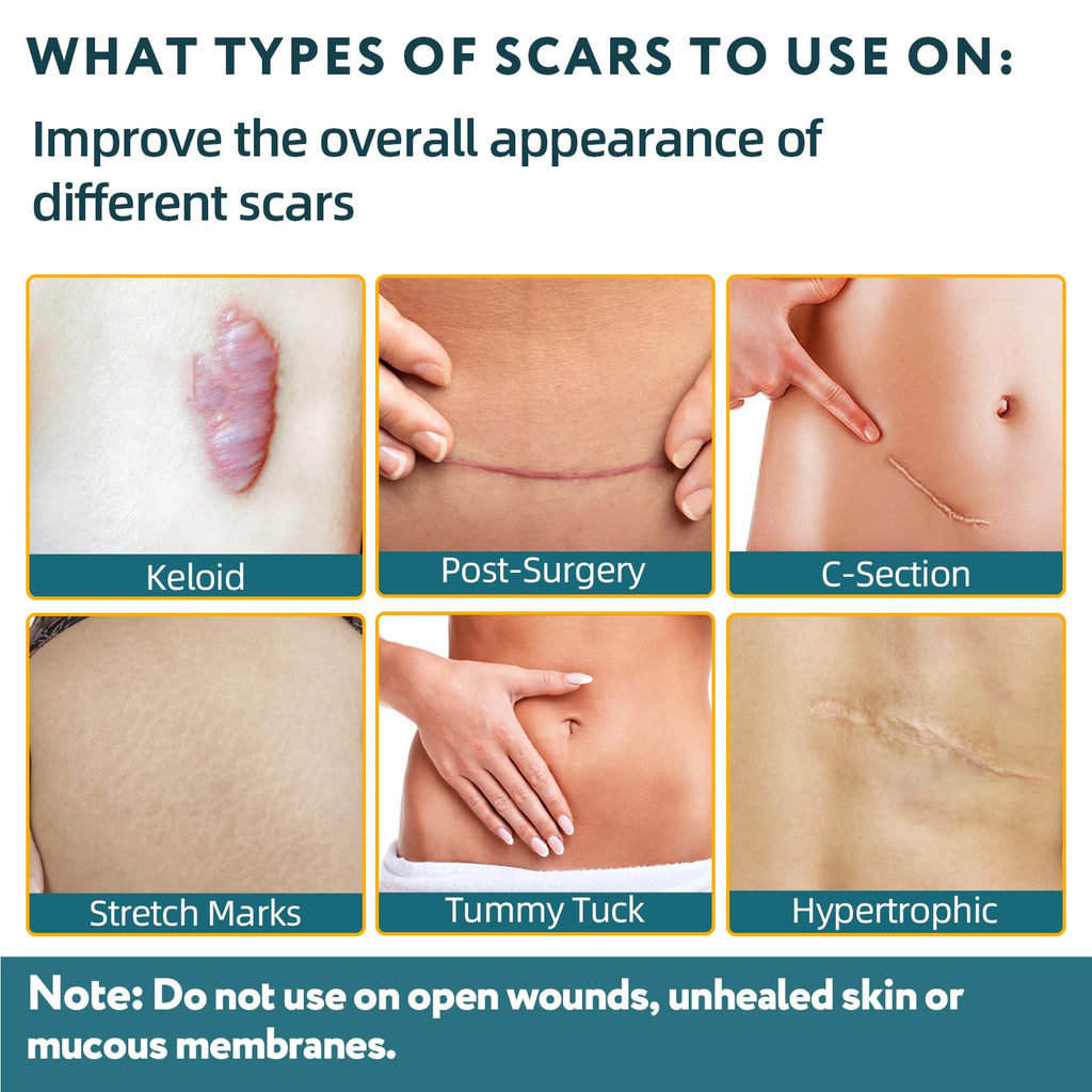 RWT Silicone Scar Sheets – 60 inch x 1.6 inch Roll for Surgical Scars
