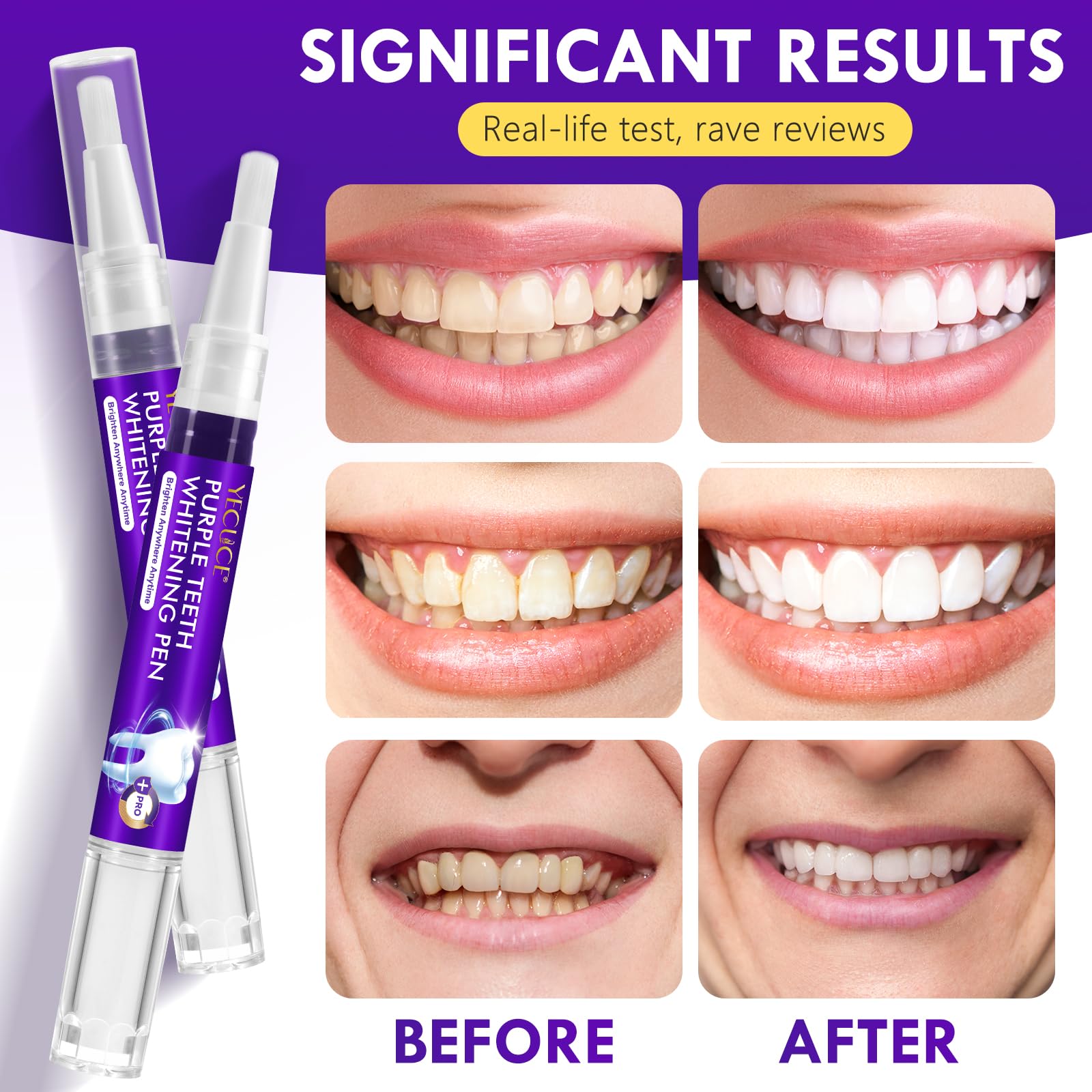 Teeth Whitening Pen 6 Pack—Purple Gel, No-Sensitivity Formula, Mint Fresh Breath