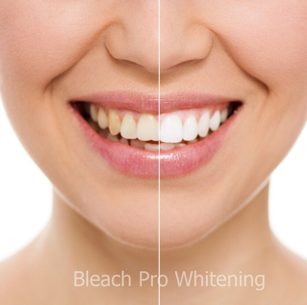Teeth Whitening Gel Syringe 10ml - 44% Carbamide Peroxide - 4 Pack