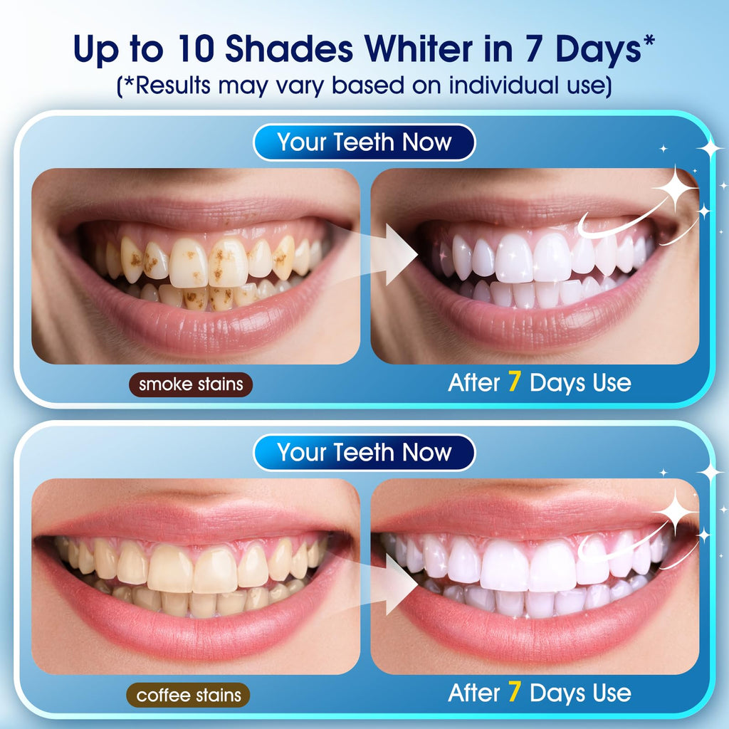 Teeth Whitening Kit – 3 Pens + 2 Desensitizing Pens | LED Light, 35% Carbamide Peroxide