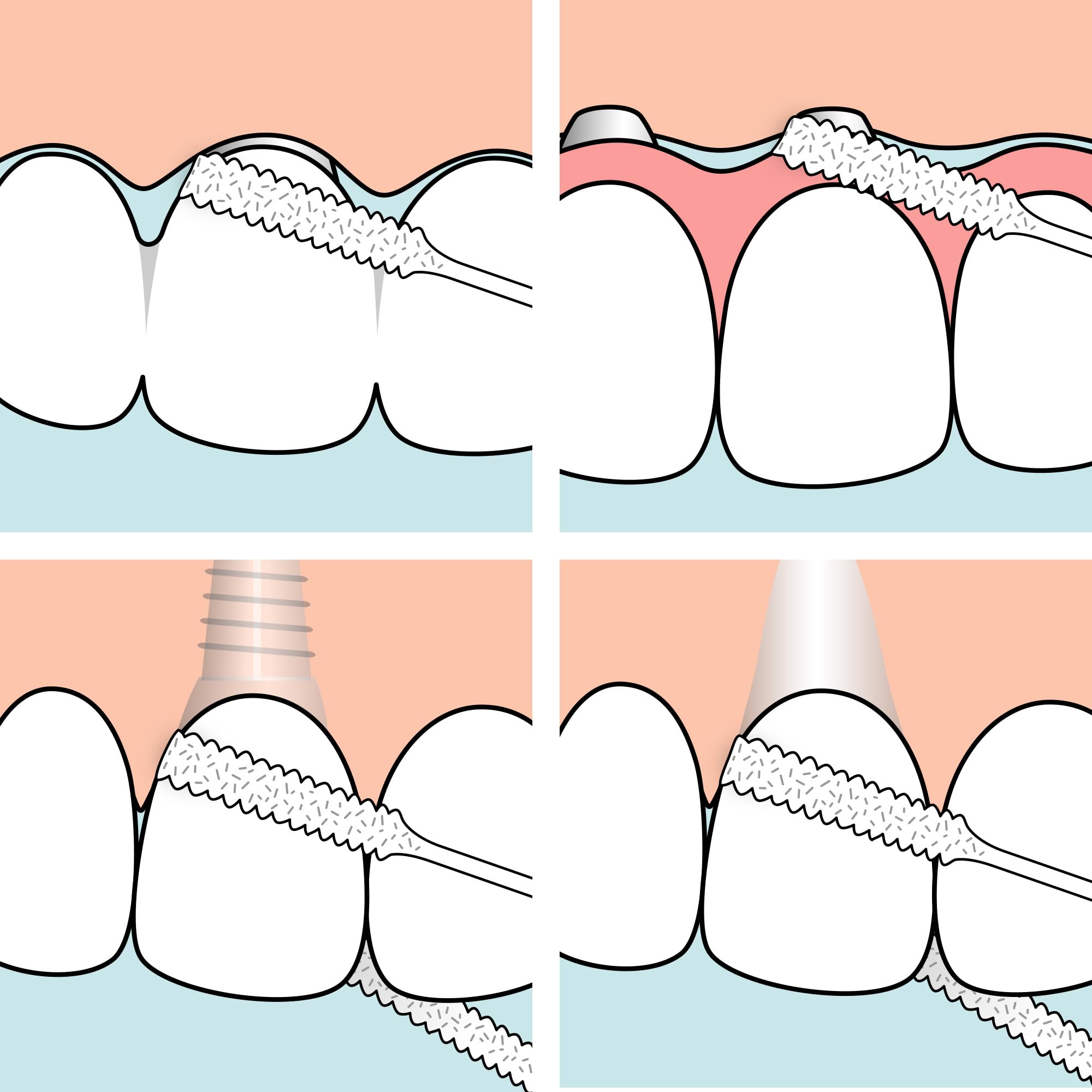 TePe Bridge & Implant Floss for Implants, Bridges & Braces – 30 Pieces